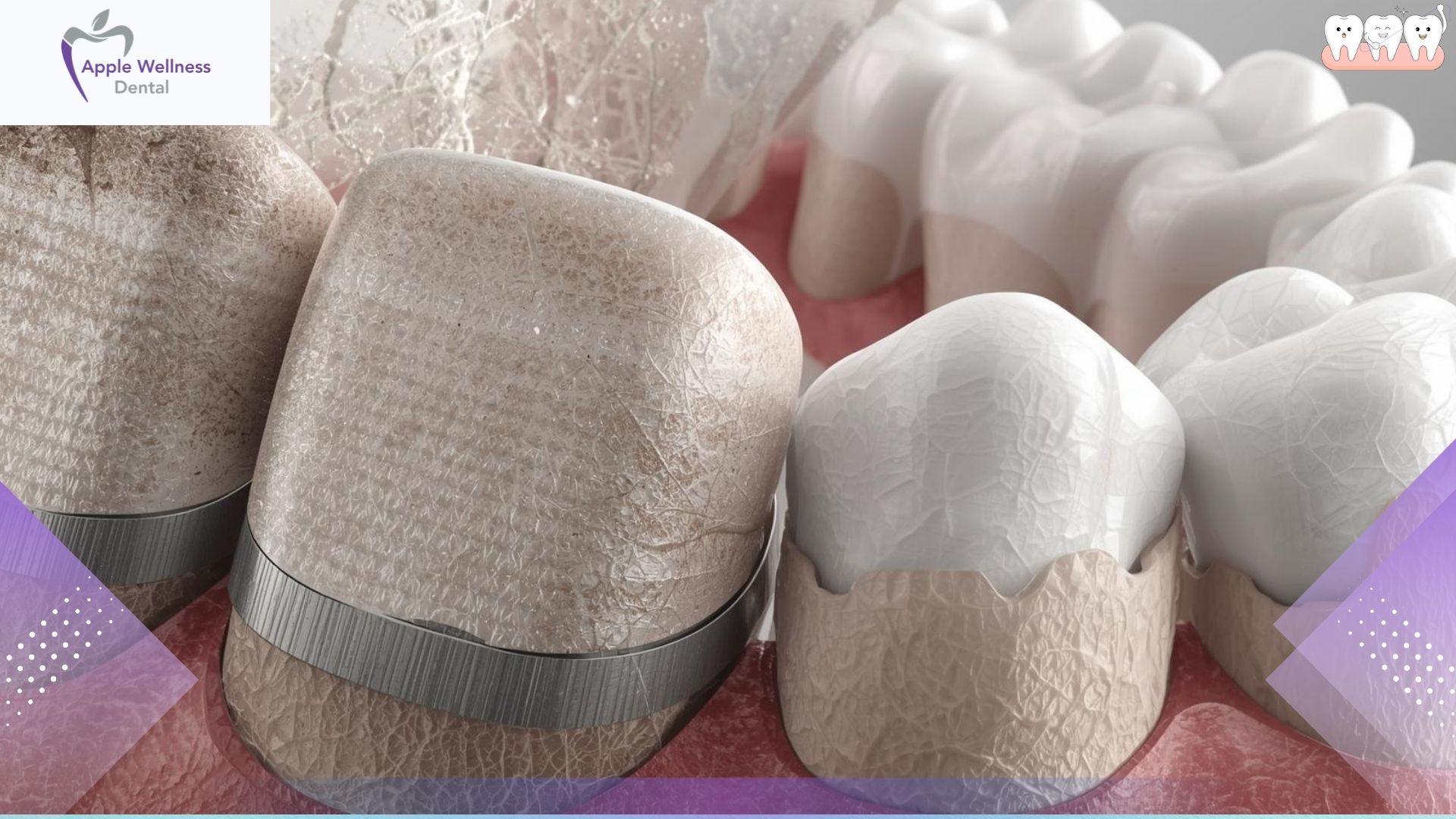 The Real Lifespan of Dental Crowns and Bridges: What to Expect - Apple Wellness Dental