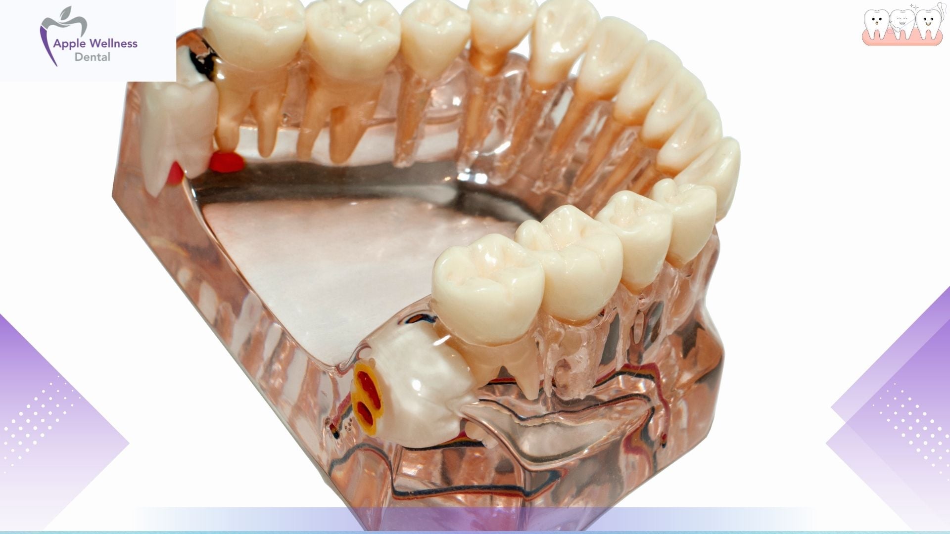 When Are Crowns and Bridges Recommended in Airdrie? Local Guide - Apple Wellness Dental