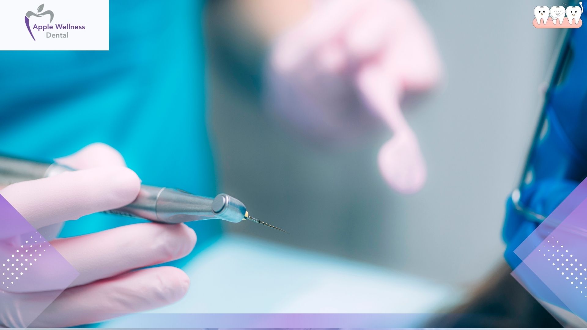 How to Care for Your Tooth After Root Canal Therapy - Apple Wellness Dental