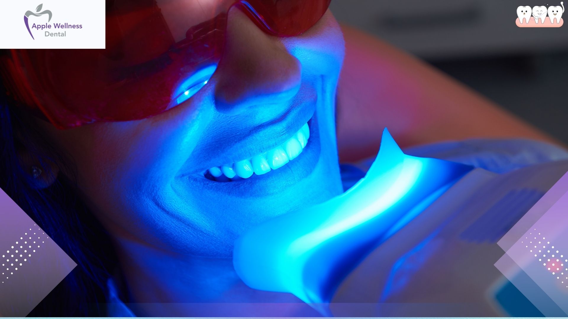How Long Does Teeth Whitening Last | Professional Results - Apple Wellness Dental
