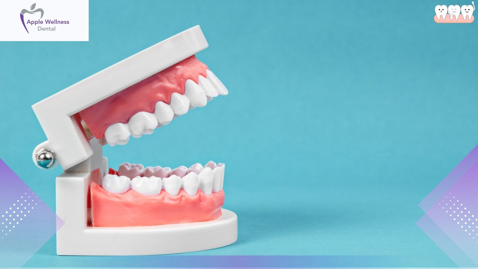 When Are Crowns and Bridges Recommended? A Patient Guide - Apple Wellness Dental