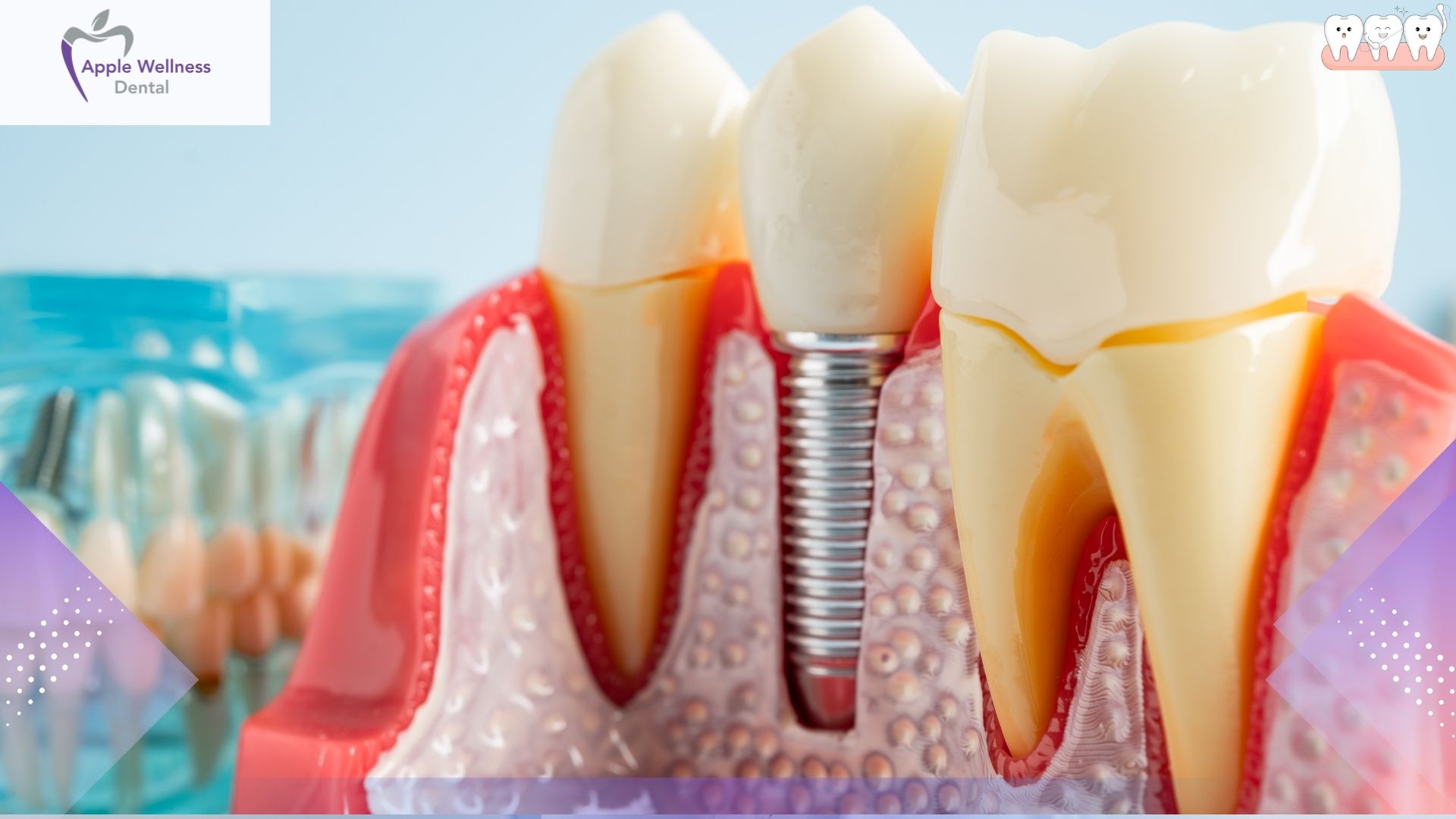 How to Care for Your Tooth After Root Canal Therapy - Apple Wellness Dental