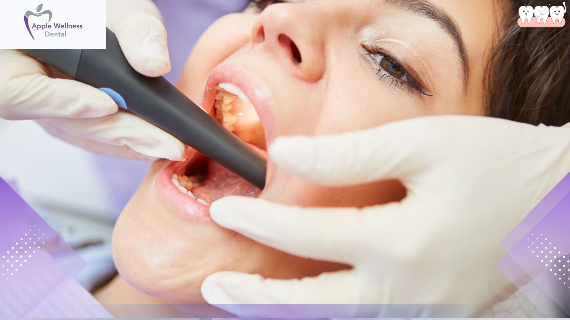 How Painful Is Root Canal Therapy in Airdrie? The Honest Truth - Apple Wellness Dental
