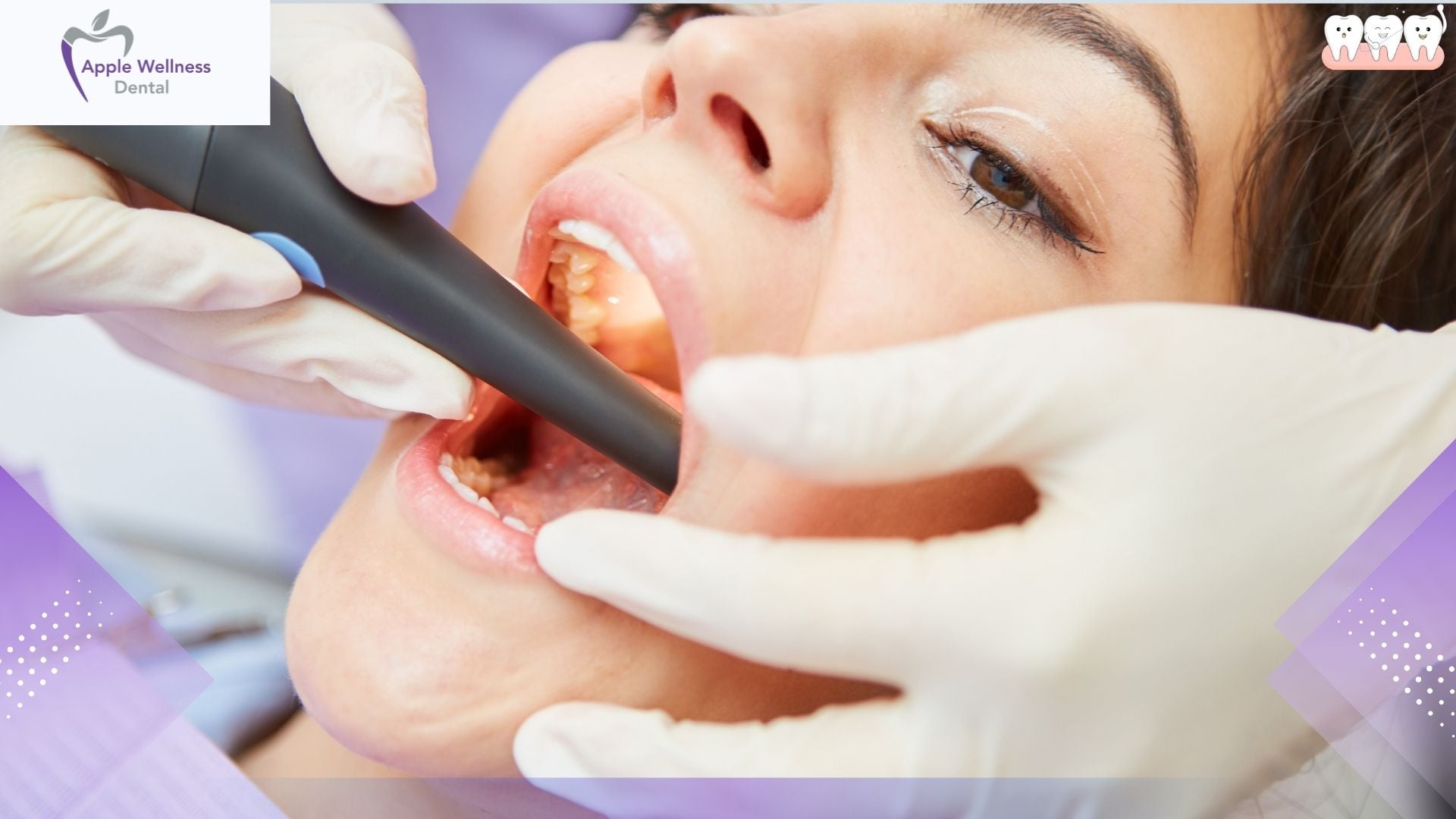 Why Is Root Canal Therapy Needed? A Patient’s Guide - Apple Wellness Dental
