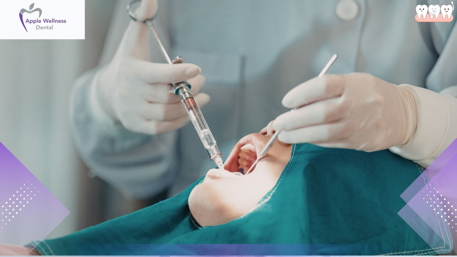 Your Guide to Root Canal Therapy in Airdrie: Understanding Comfort and Care - Apple Wellness Dental
