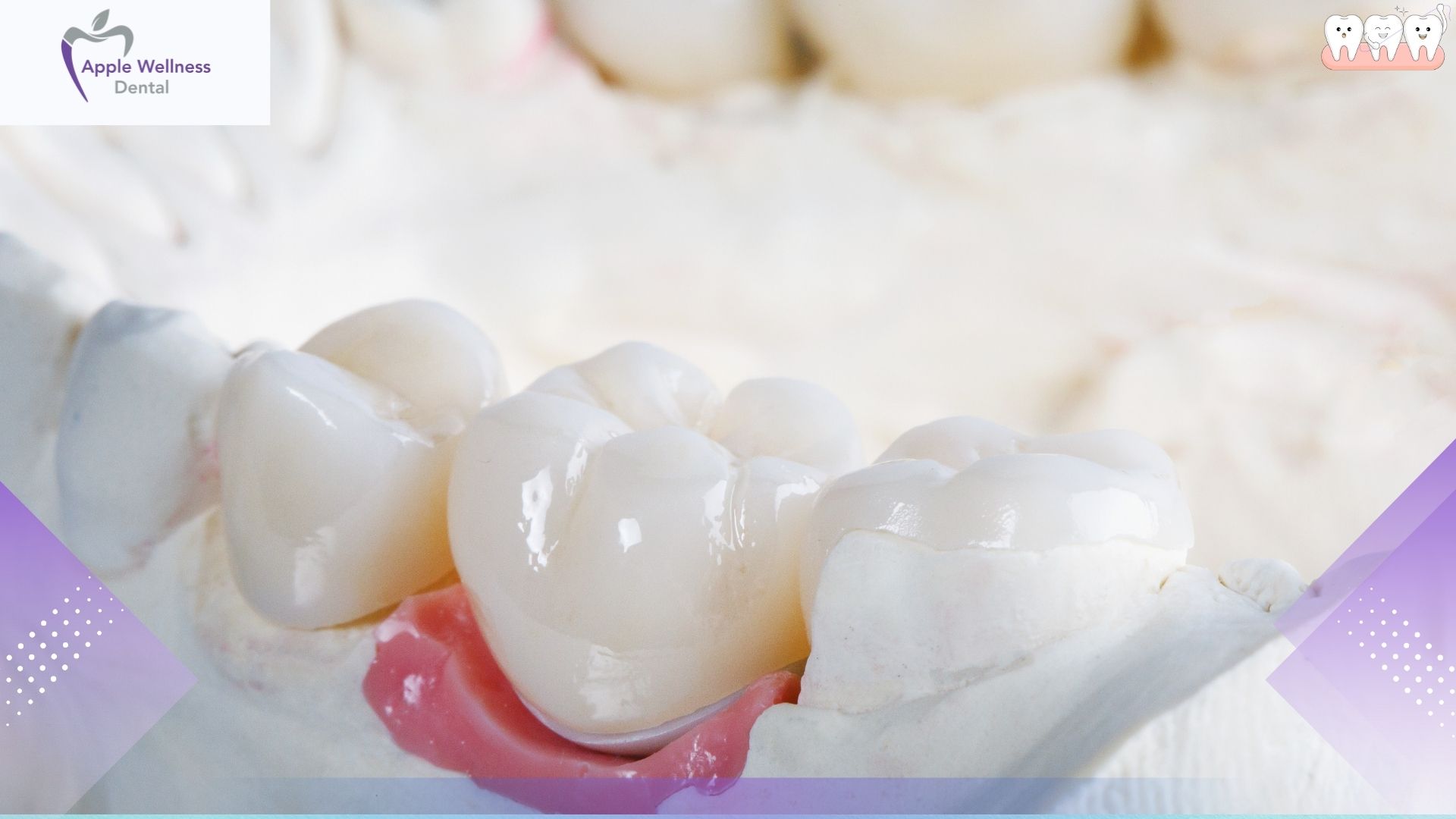 When Are Crowns and Bridges Recommended? A Patient Guide - Apple Wellness Dental