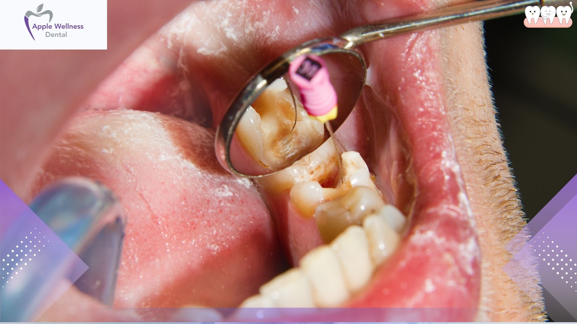 The Truth About Root Canal Pain and Recovery - Apple Wellness Dental The Truth About Root Canal Pain and Recovery - Apple Wellness Dental