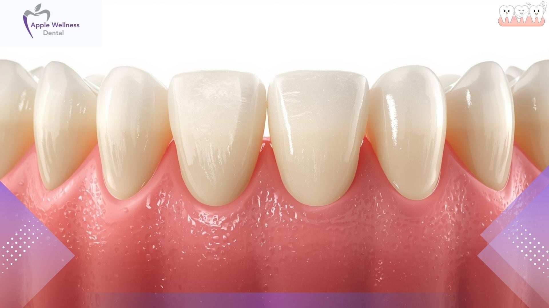Making Your Restorations Last: What Airdrie Patients Need to Know About Crown Longevity - Apple Wellness Dental