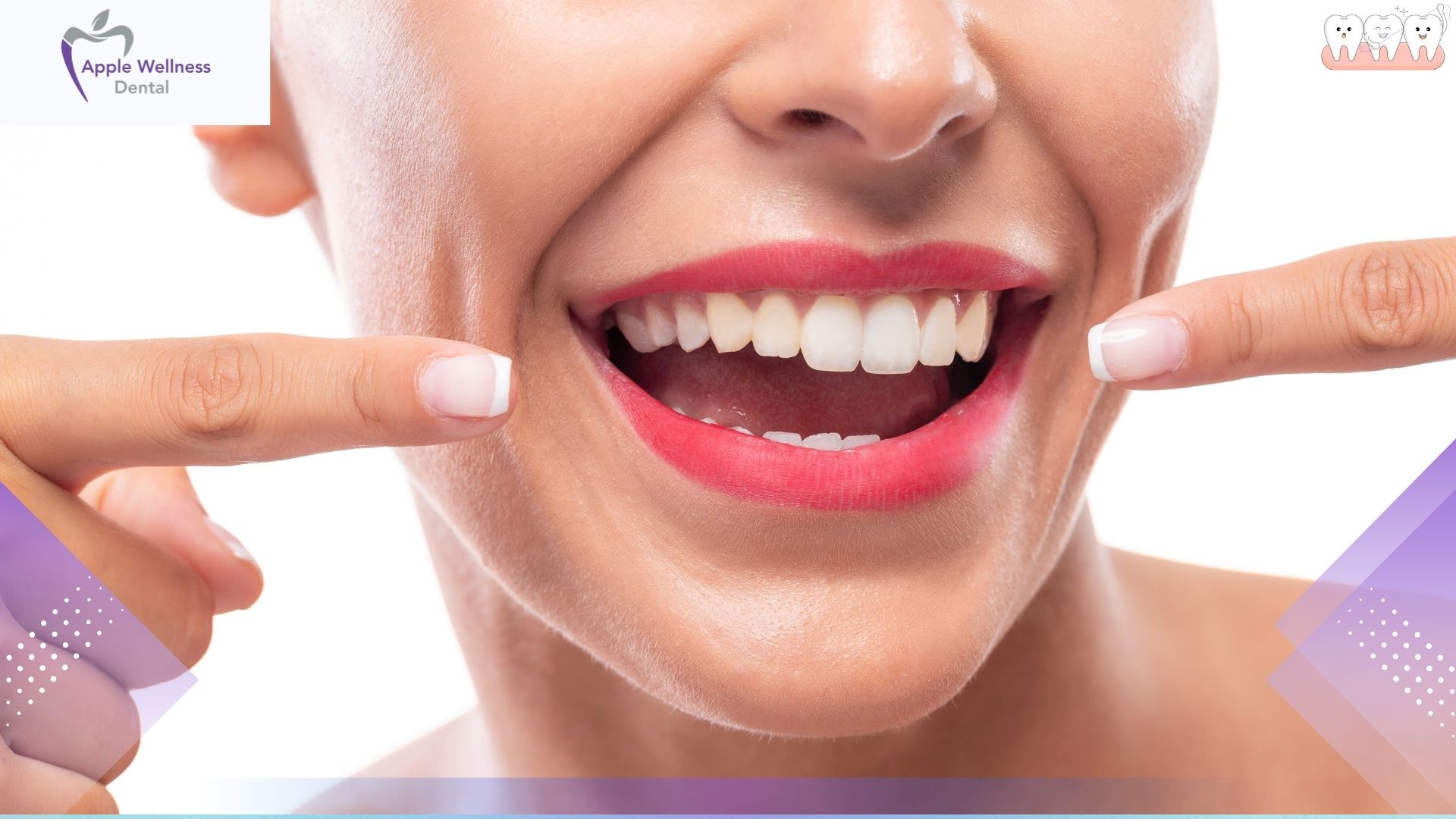 What Are the Risks of Teeth Whitening in Airdrie? Safety Guide - Apple Wellness Dental