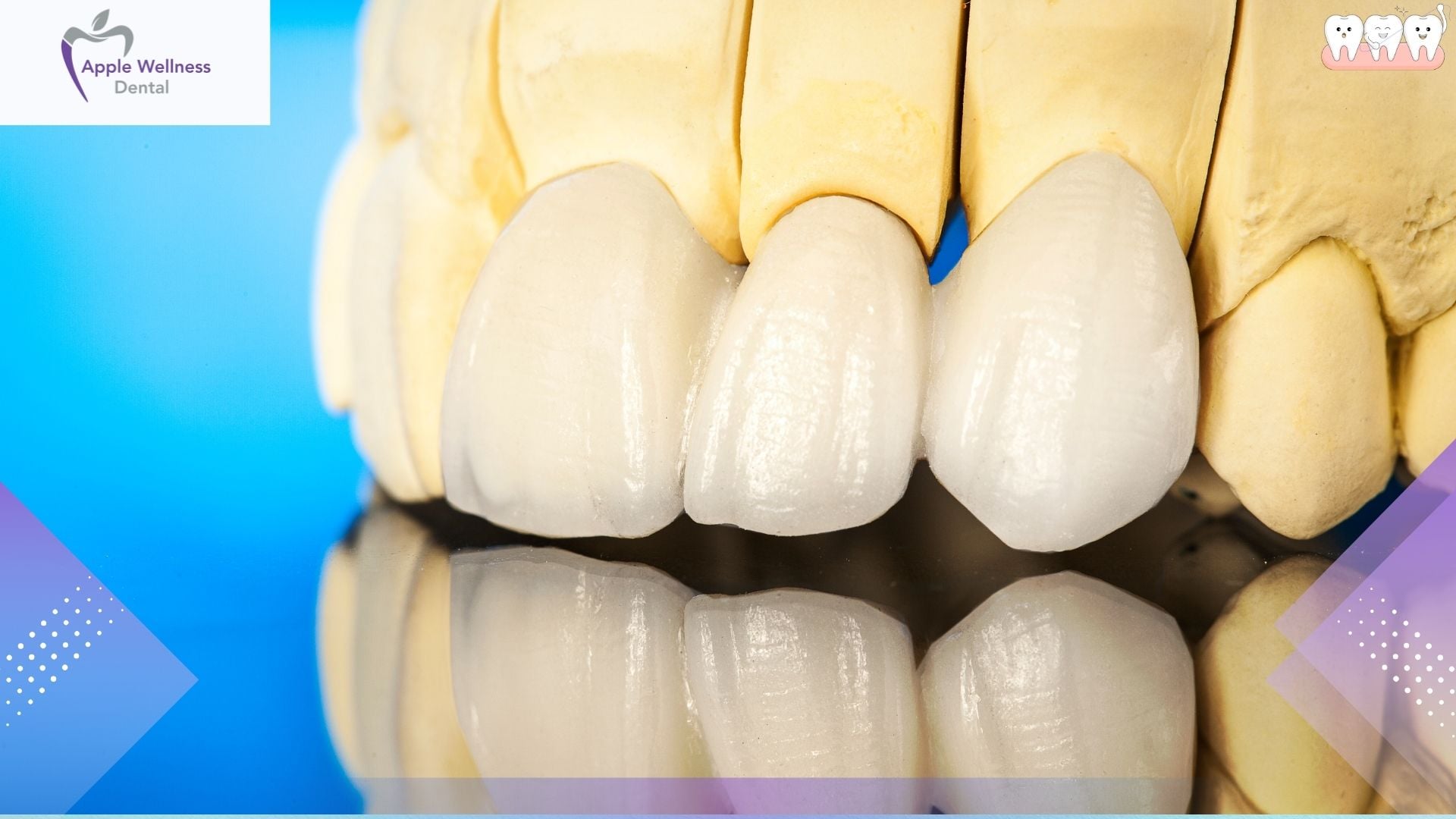 When Are Crowns and Bridges Recommended in Airdrie? Local Guide - Apple Wellness Dental