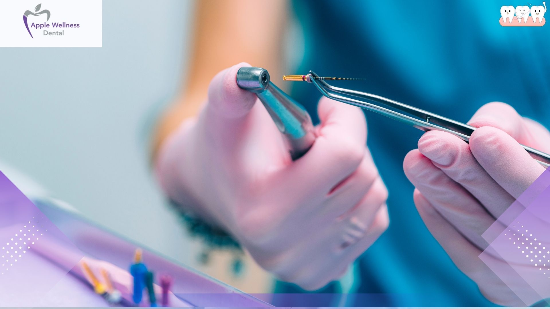 How Long Does a Root Canal Procedure Take in Airdrie - Apple Wellness Dental