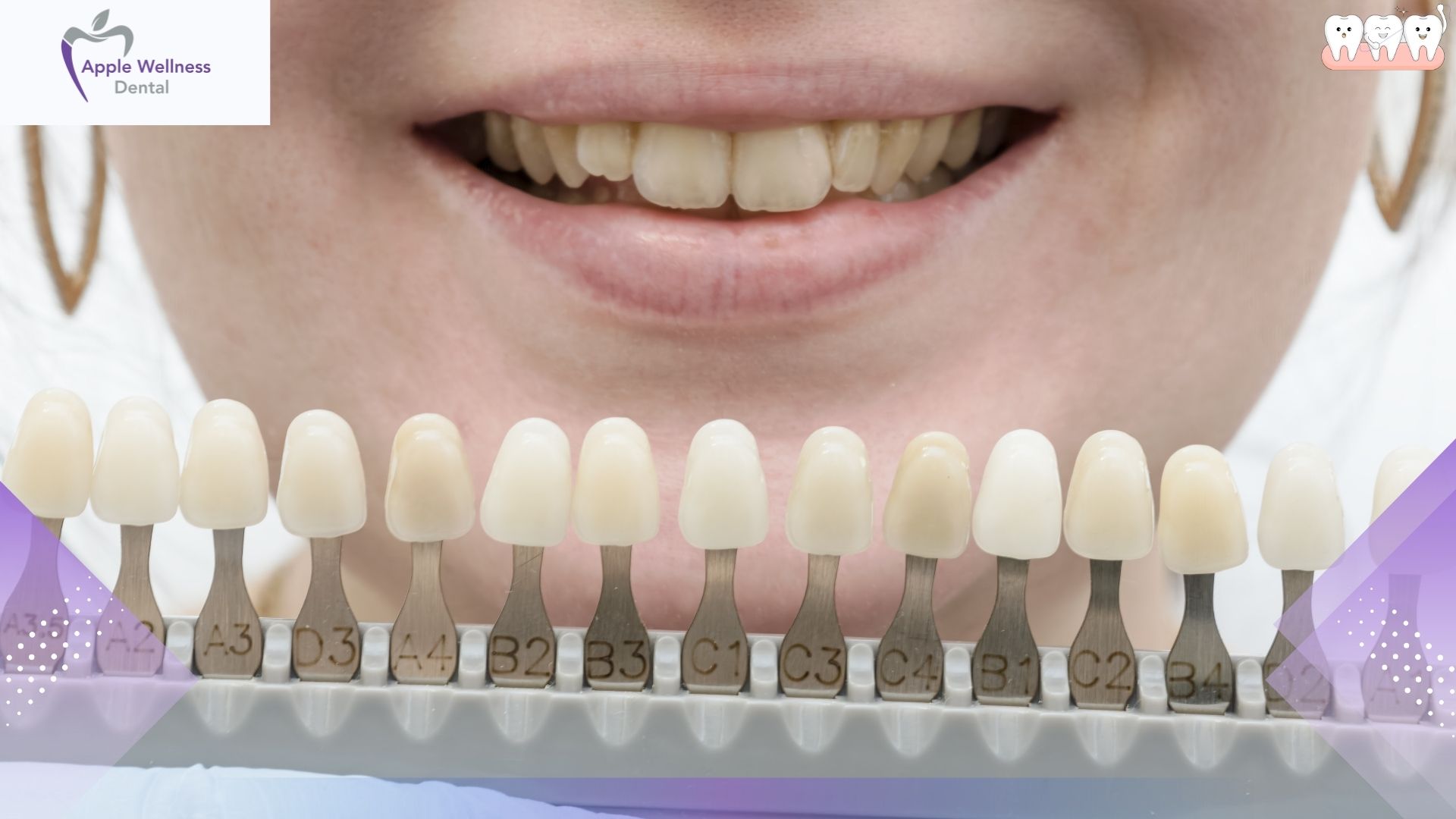 Restoring Your Bite: What to Expect During Your Crown or Bridge Appointments - Apple Wellness Dental Restoring Your Bite: What to Expect During Your Crown or Bridge Appointments - Apple Wellness Dental