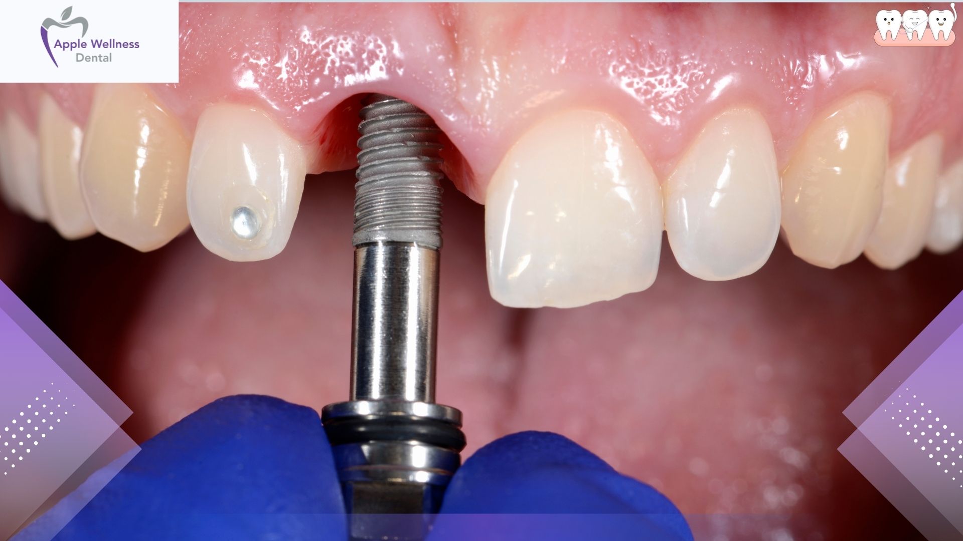 From Consultation to Smile: The Full Process of Getting Dental Implants - Apple Wellness Dental