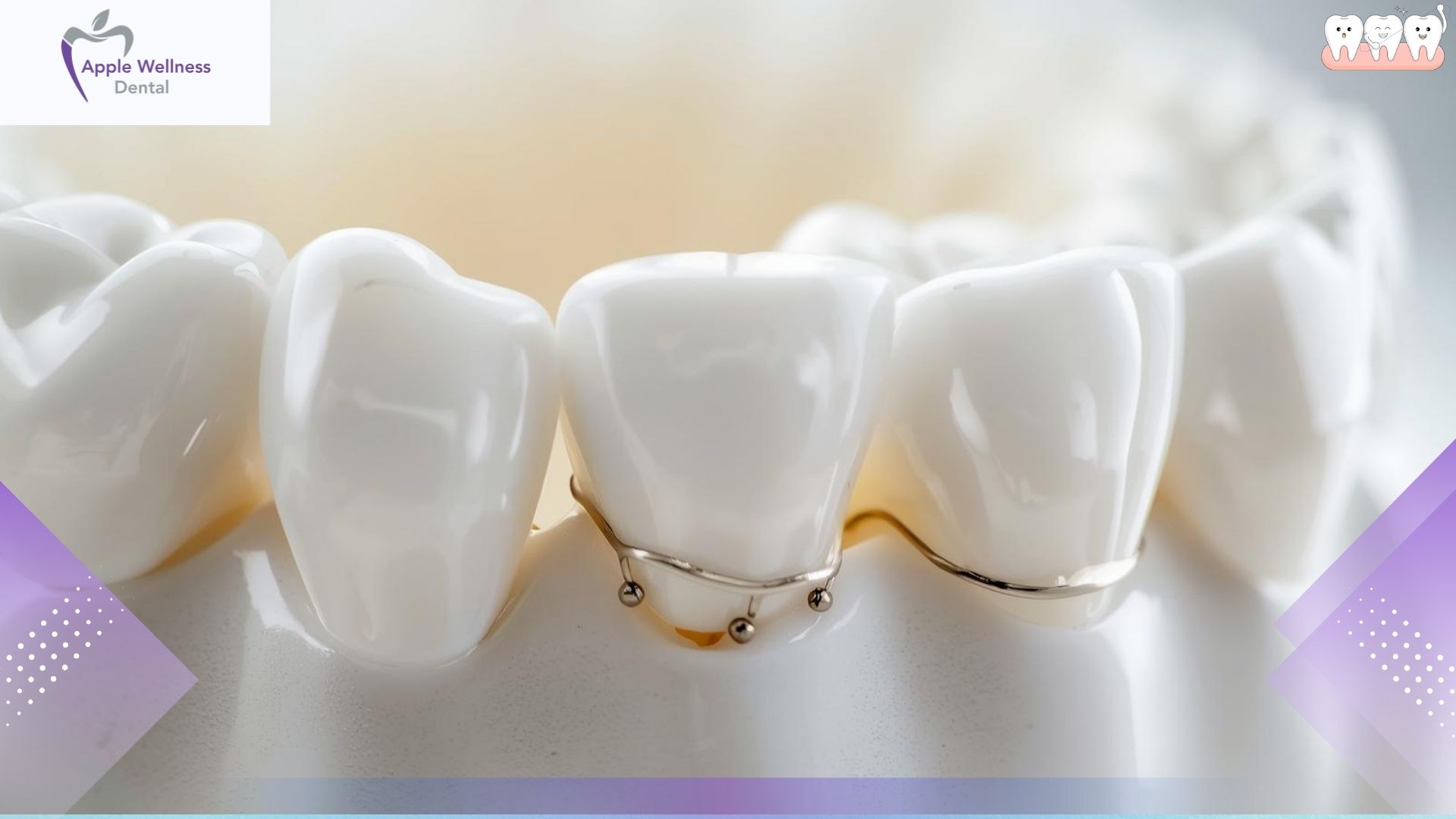 The Real Lifespan of Dental Crowns and Bridges: What to Expect - Apple Wellness Dental