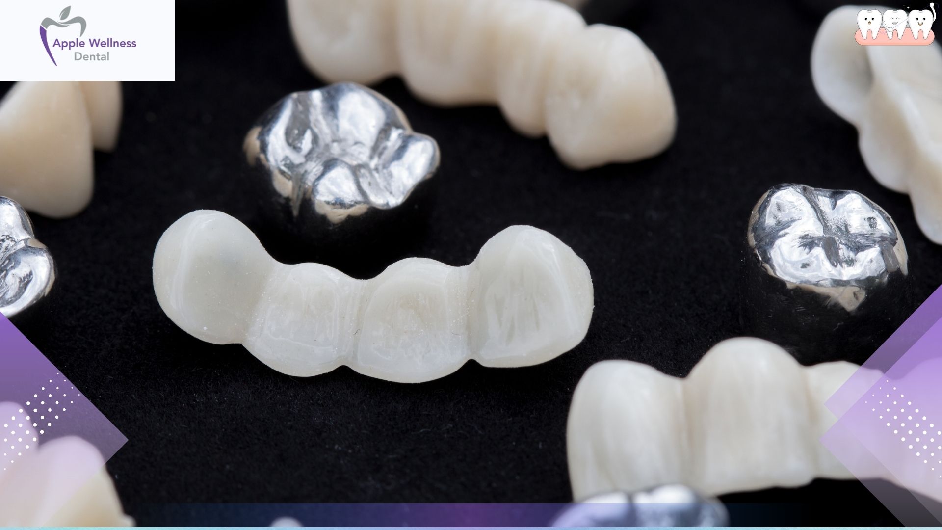 What Are Dental Crowns and Bridges? A Comprehensive Guide - Apple Wellness Dental