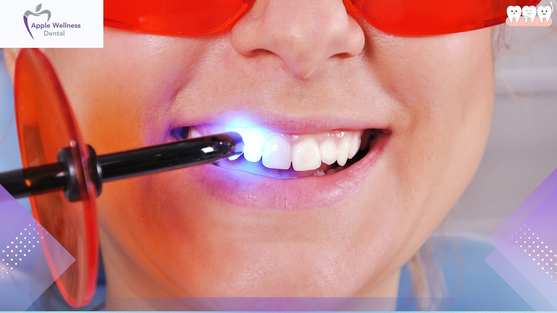 How Does Professional Teeth Whitening Work in Airdrie - Apple Wellness Dental How Does Professional Teeth Whitening Work in Airdrie - Apple Wellness Dental