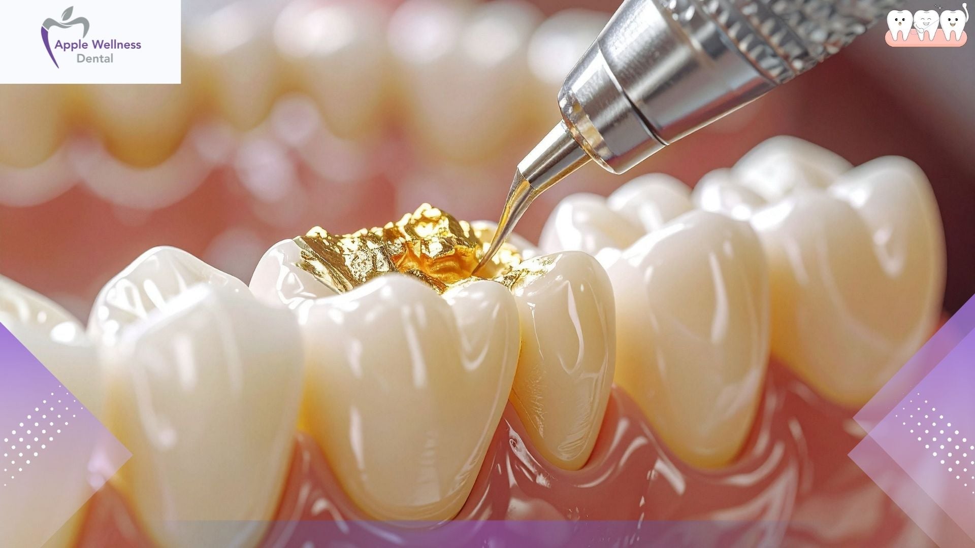 Restorative Dentistry Explained: How We Rebuild Your Smile’s Function - Apple Wellness Dental