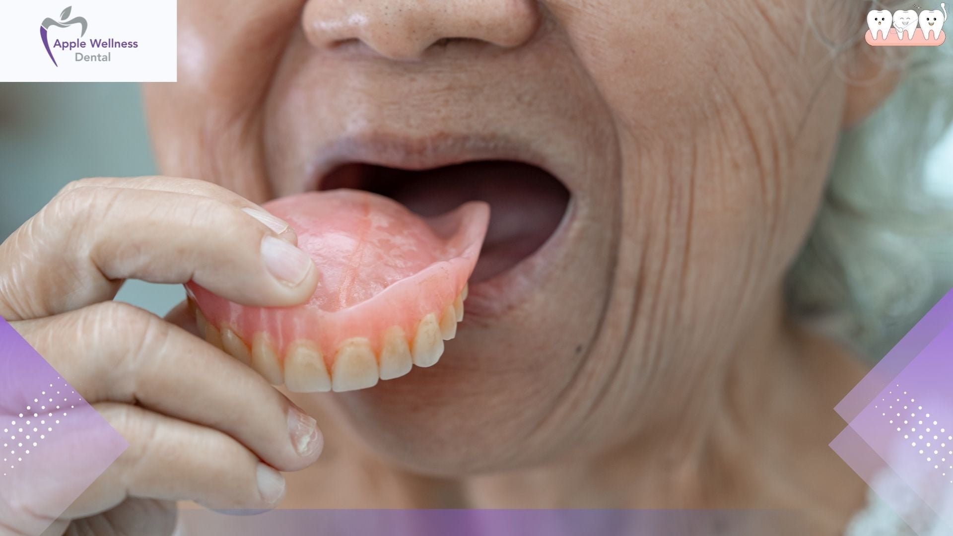 How Long Do Dentures Last in Airdrie? Expert Lifespan Guide - Apple Wellness Dental
