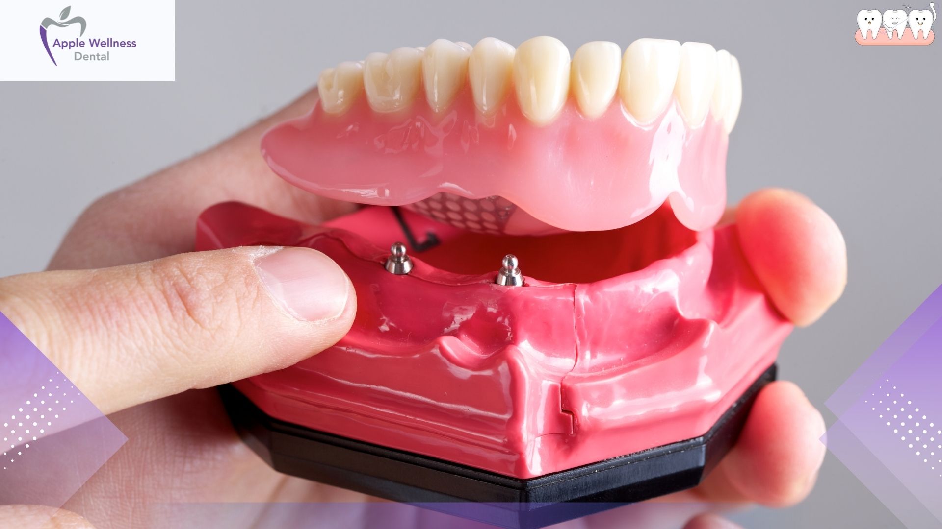 What Are Dentures Made Of? Understanding Your New Smile - Apple Wellness Dental