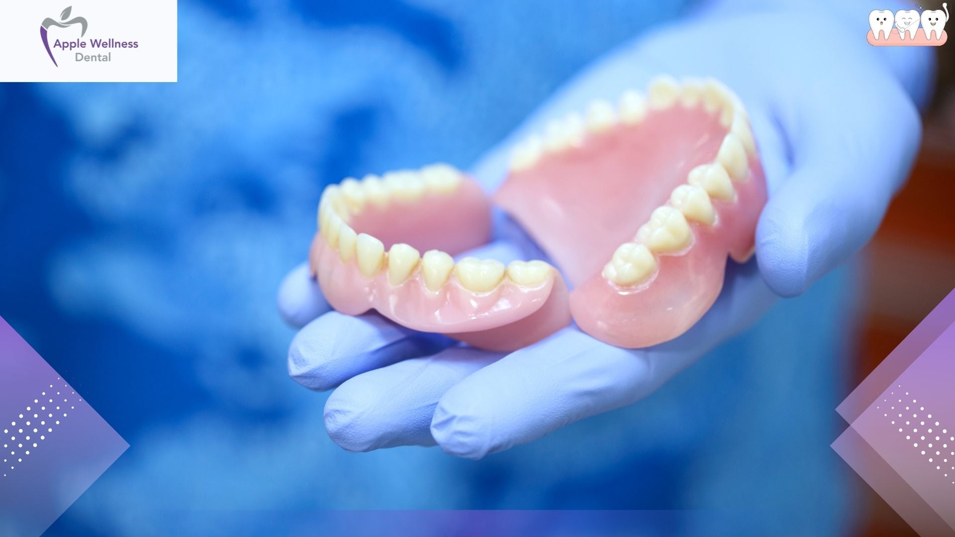 How Long Do Dentures Last? Lifespan & Replacement Guide - Apple Wellness Dental