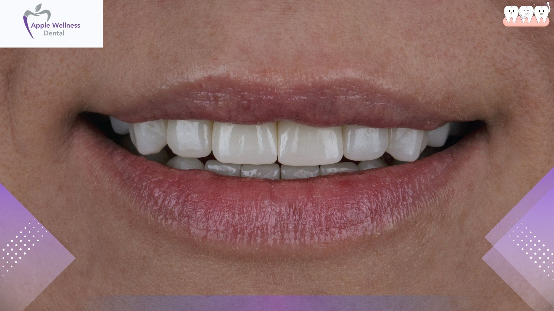 Why Is Restorative Dentistry Important? A Guide to Oral Health - Apple Wellness Dental