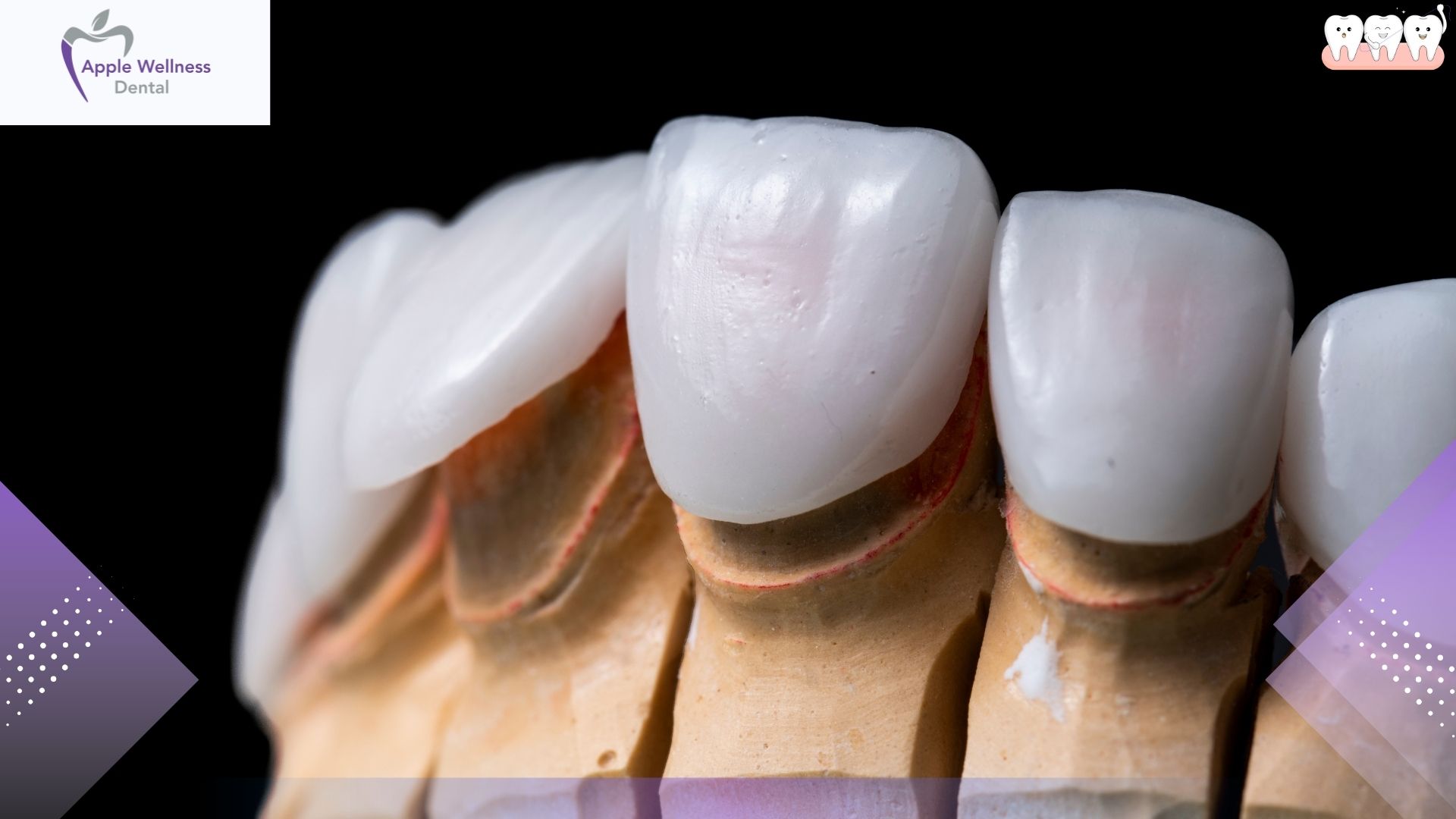 Beyond the Basics: A Comprehensive Guide to Crown and Bridge Composition - Apple Wellness Dental