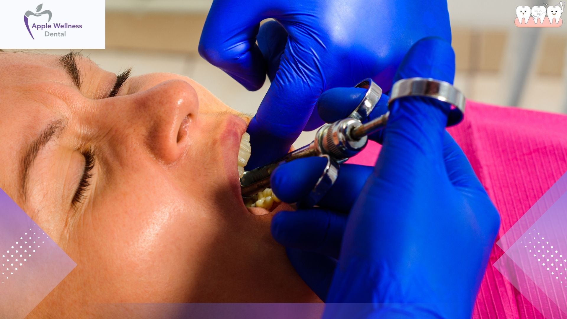 How Long Does Dental Freezing Last After Your Appointment? - Apple Wellness Dental