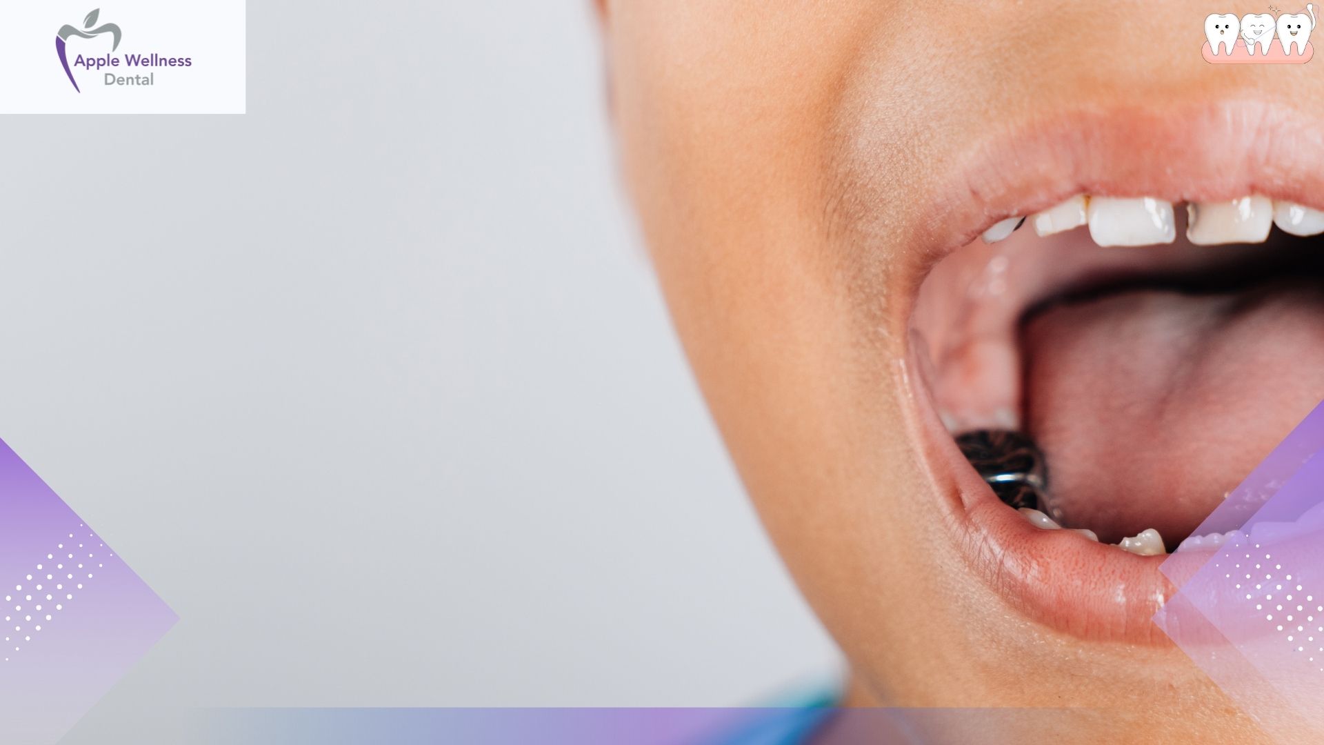 Chipped Tooth Treatment: Options for Restoring Your Smile Safely - Apple Wellness Dental
