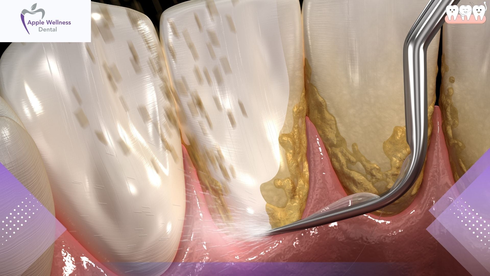 Understanding Deep Cleaning: What Does Dental Scaling Remove? - Apple Wellness Dental