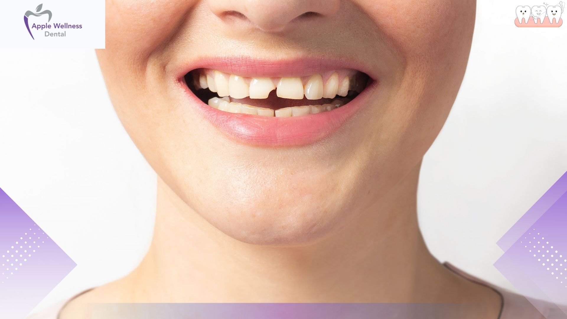 Chipped Tooth Treatment: Options for Restoring Your Smile Safely - Apple Wellness Dental