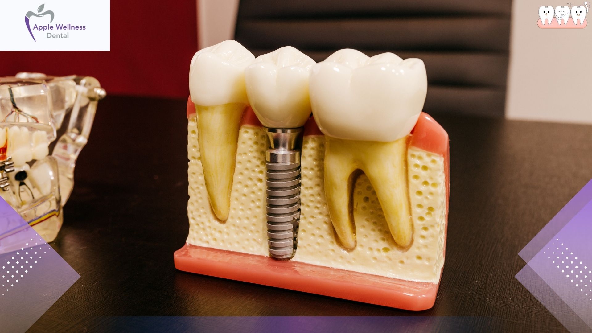 Step‑By‑Step: How Dental Implant Placement Restores Your Smile - Apple Wellness Dental