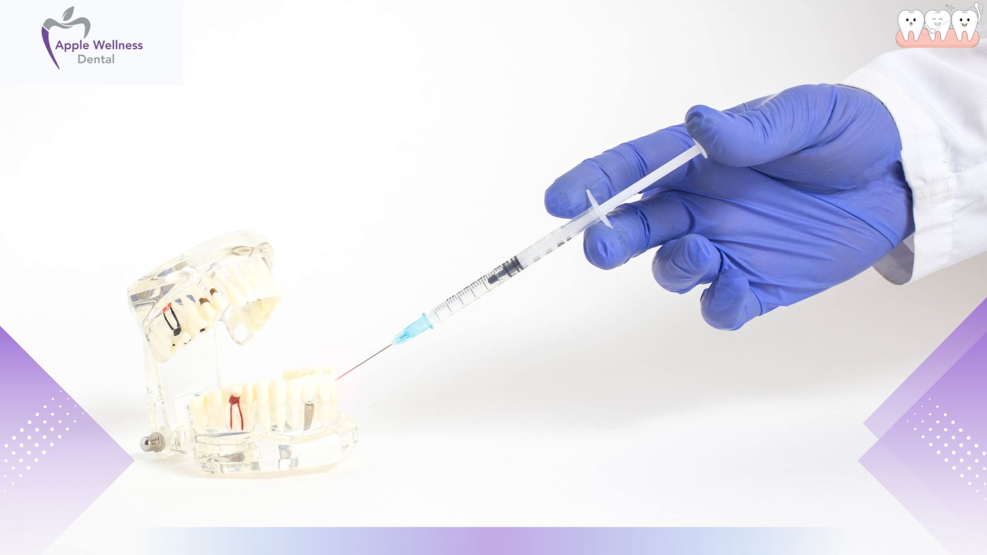 Everything You Need to Know: How Long Does Dental Freezing Last in Airdrie? - Apple Wellness Dental