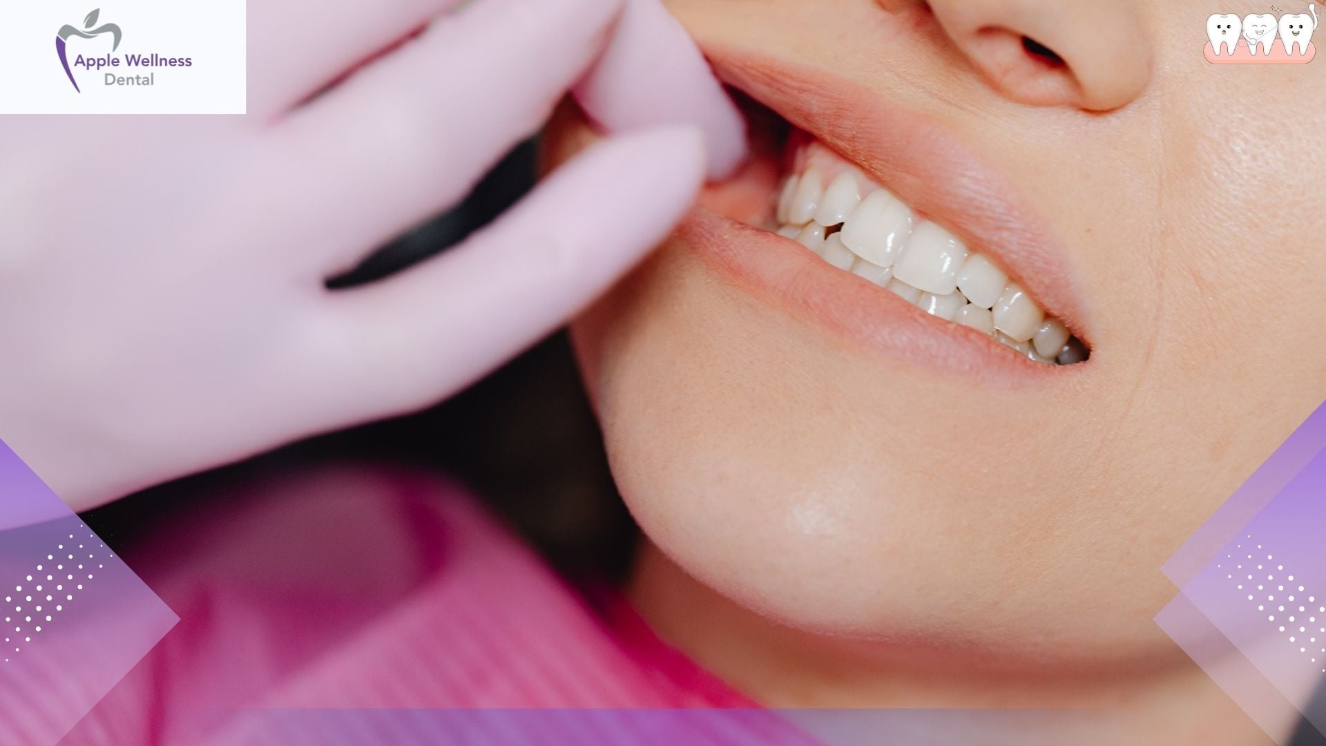 Dental Cavity Detection Technology: How Dentists Find Decay Earlier Than Ever - Apple Wellness Dental