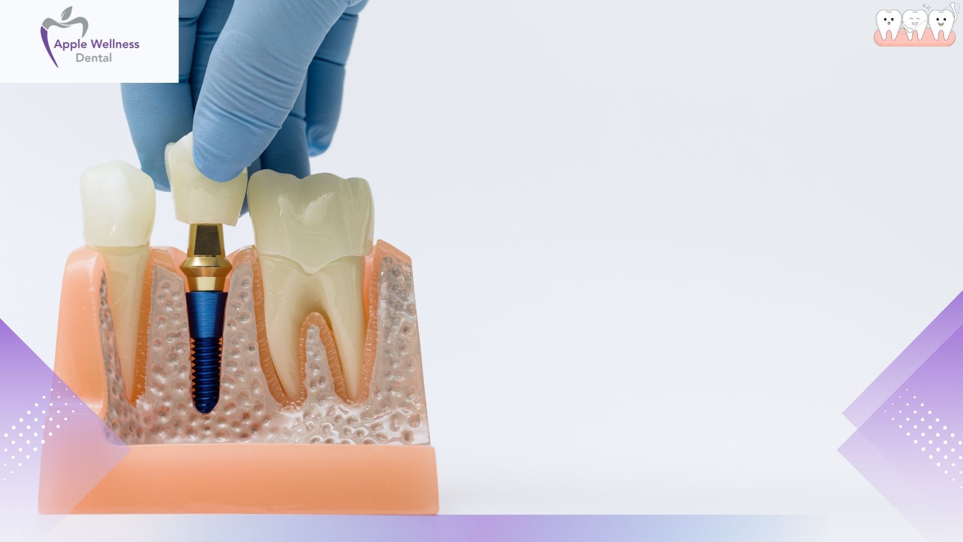 Step‑By‑Step: How Dental Implant Placement Restores Your Smile - Apple Wellness Dental