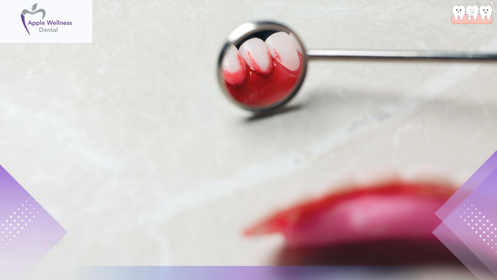 How to Stop Bleeding After Tooth Extraction - Apple Wellness Dental