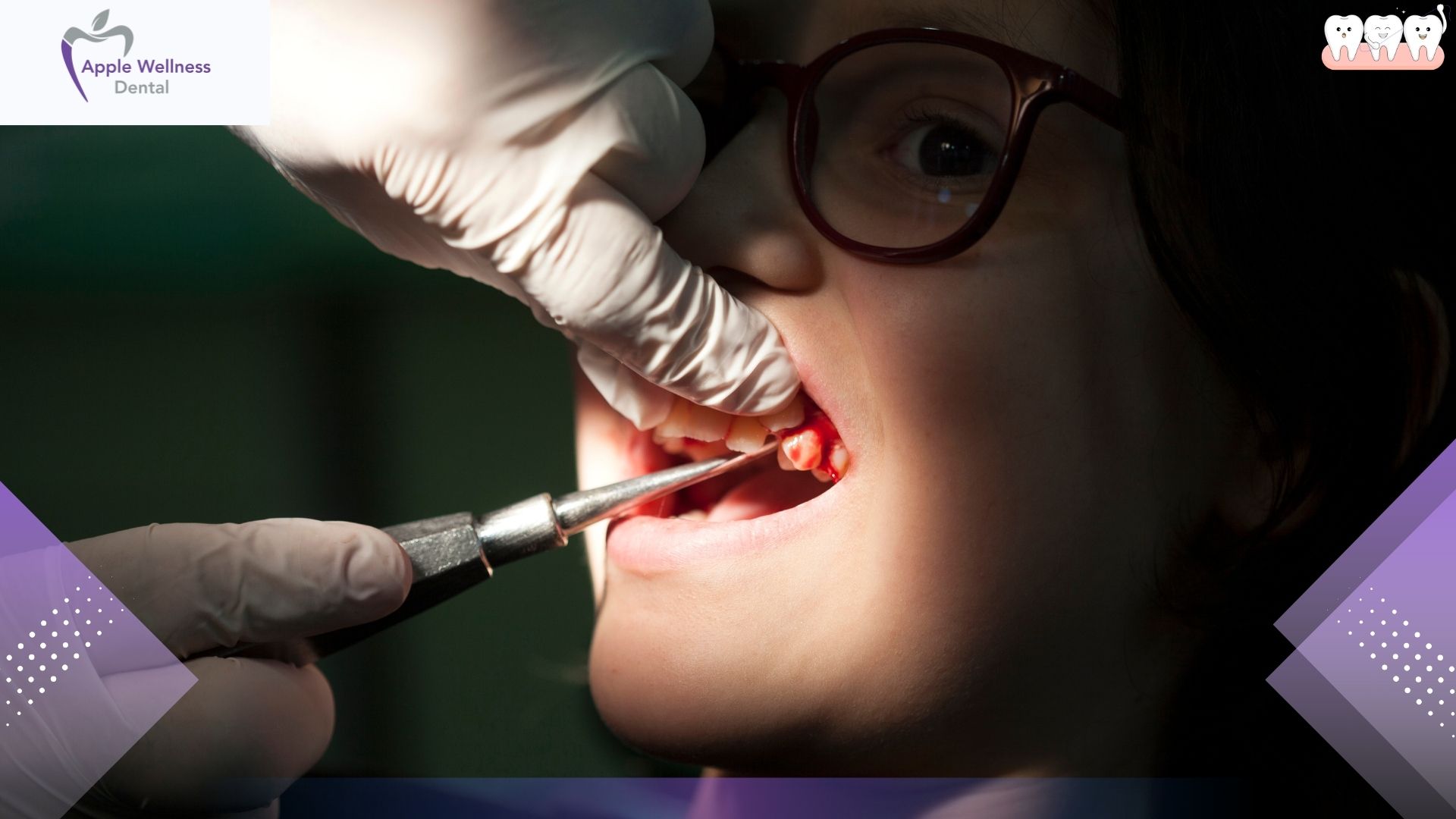 When Can I Brush My Teeth After Tooth Extraction - Apple Wellness Dental