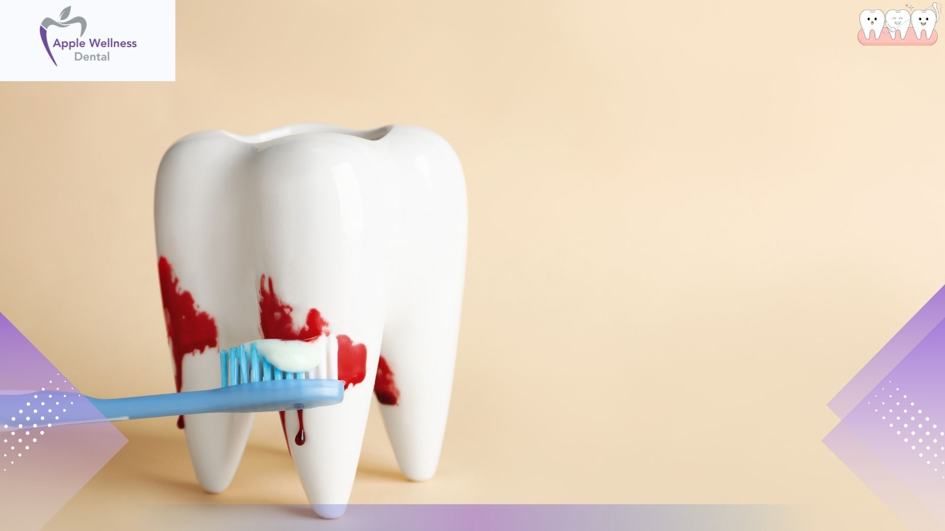 How to Stop Bleeding After Tooth Extraction - Apple Wellness Dental