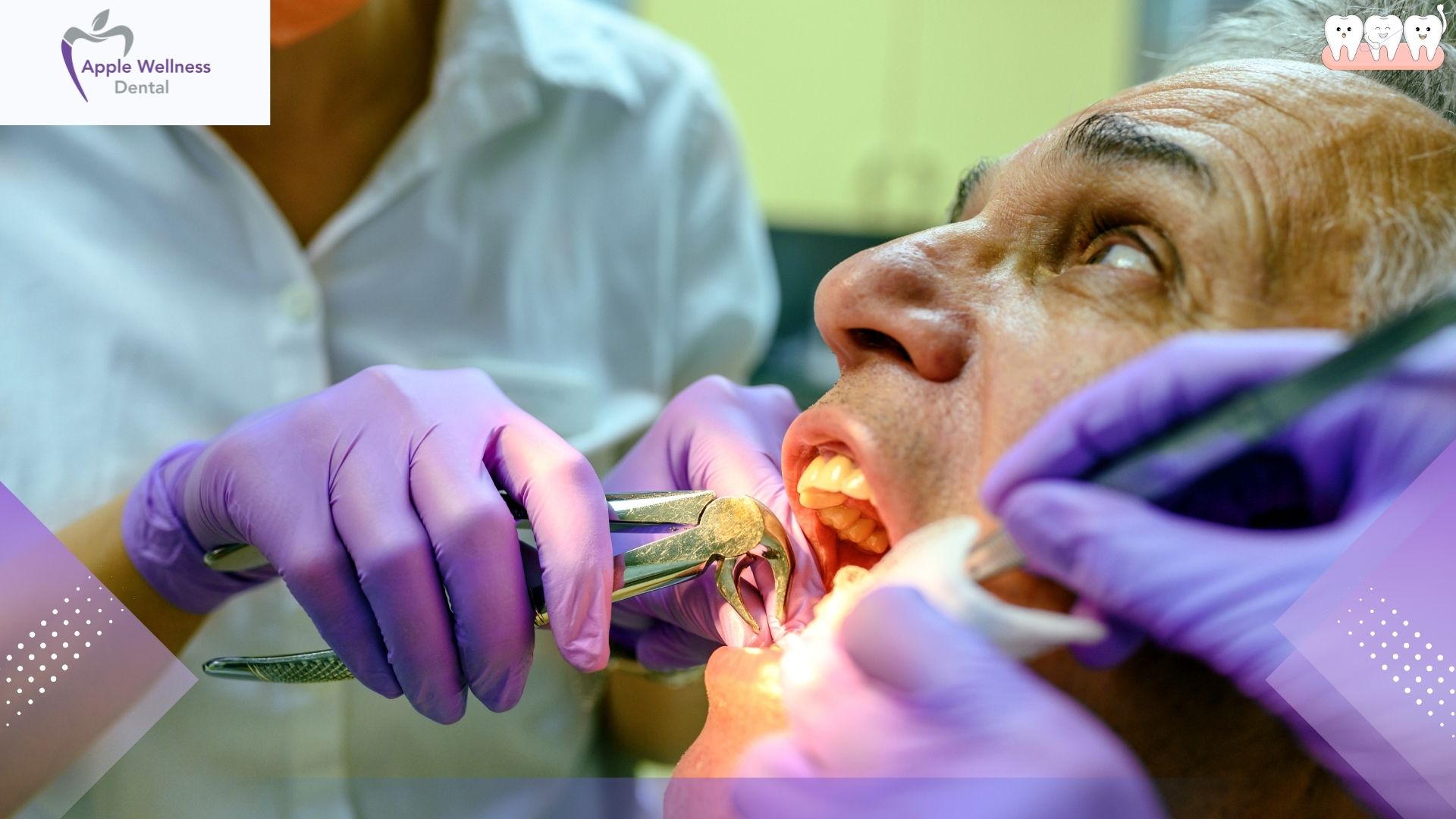 Can I Use a Straw 1 Week After Tooth Extraction - Apple Wellness Dental