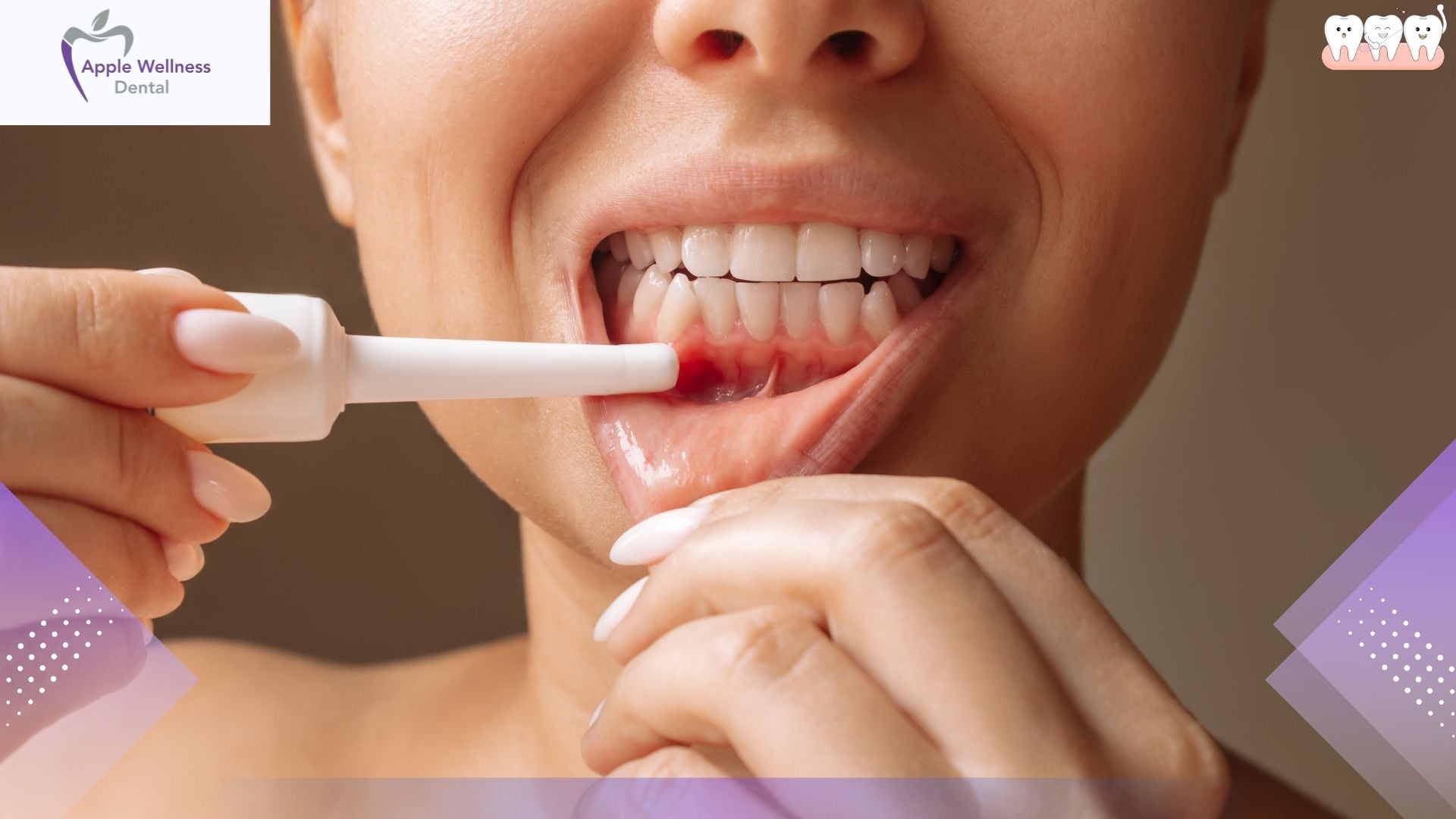 What Happens If Bleeding Doesn't Stop After Tooth Extraction - Apple Wellness Dental