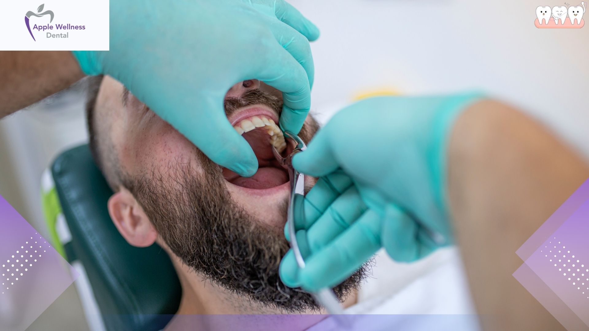 When Can I Brush My Teeth After Tooth Extraction - Apple Wellness Dental