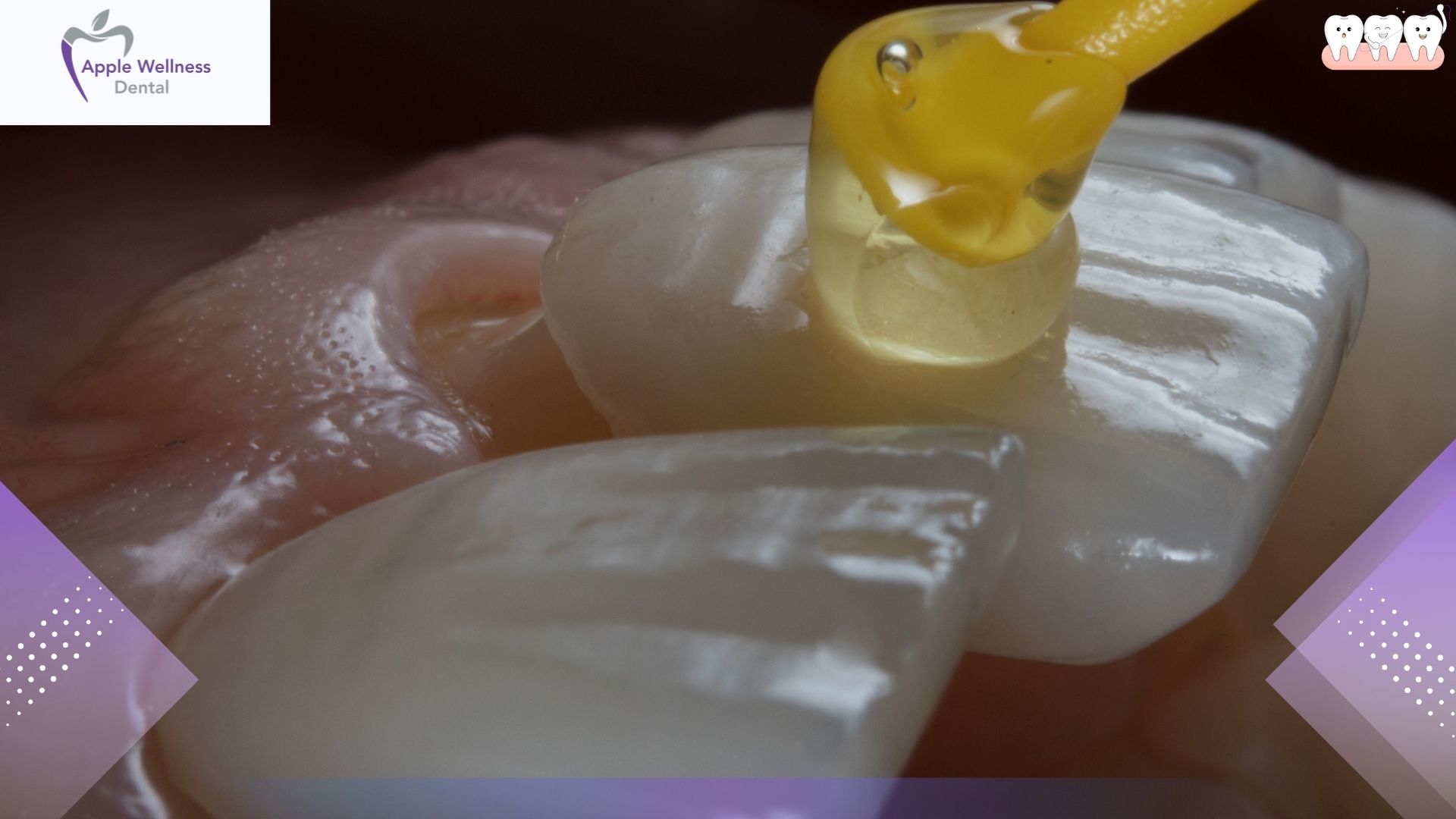 The Truth About Smile Makeovers: Why Veneers Are Bad If Rushed - Apple Wellness Dental