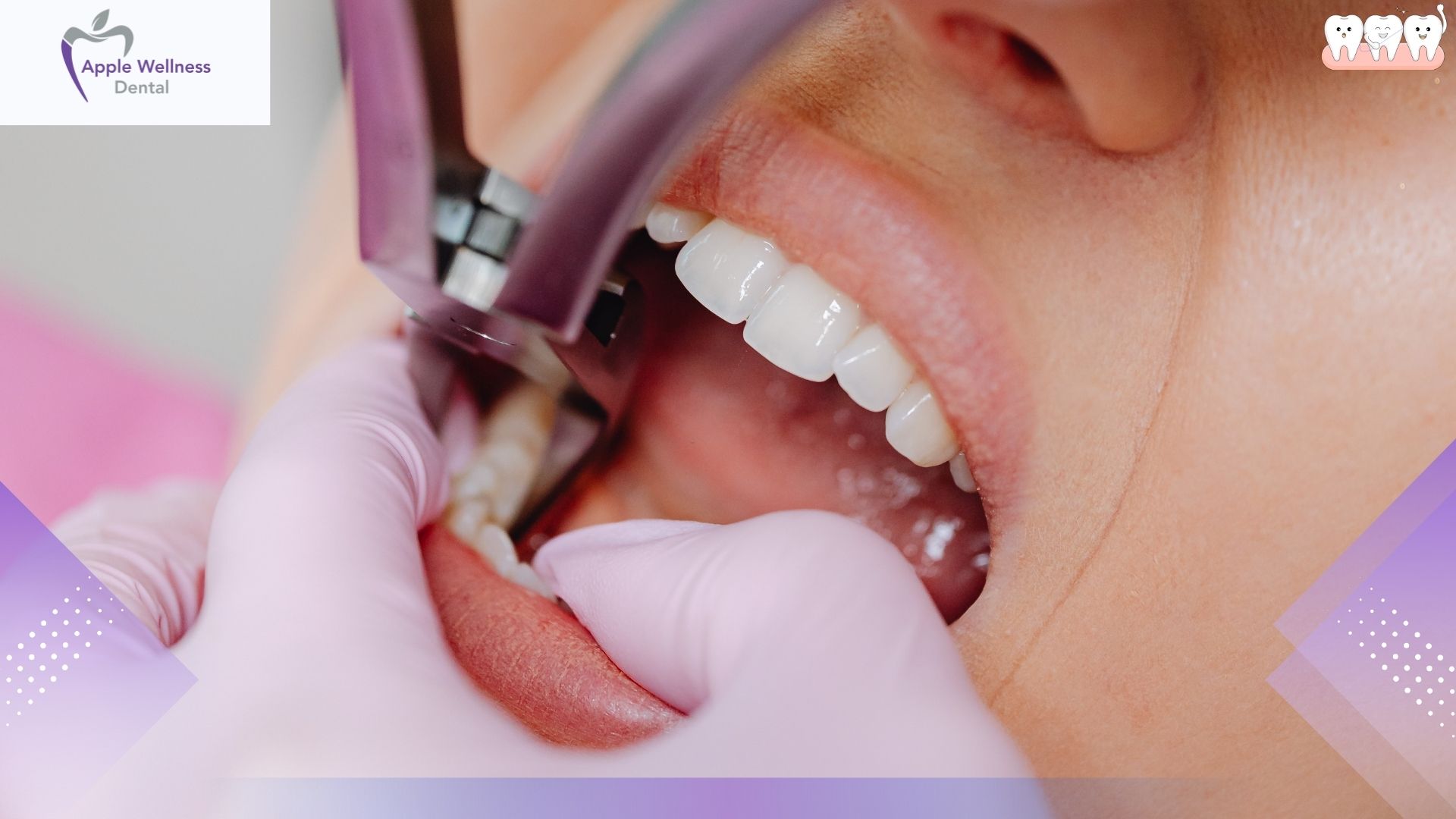 Alcohol After Tooth Extraction: When It's Safe, Risks, and a Complete Recovery Timeline - Apple Wellness Dental
