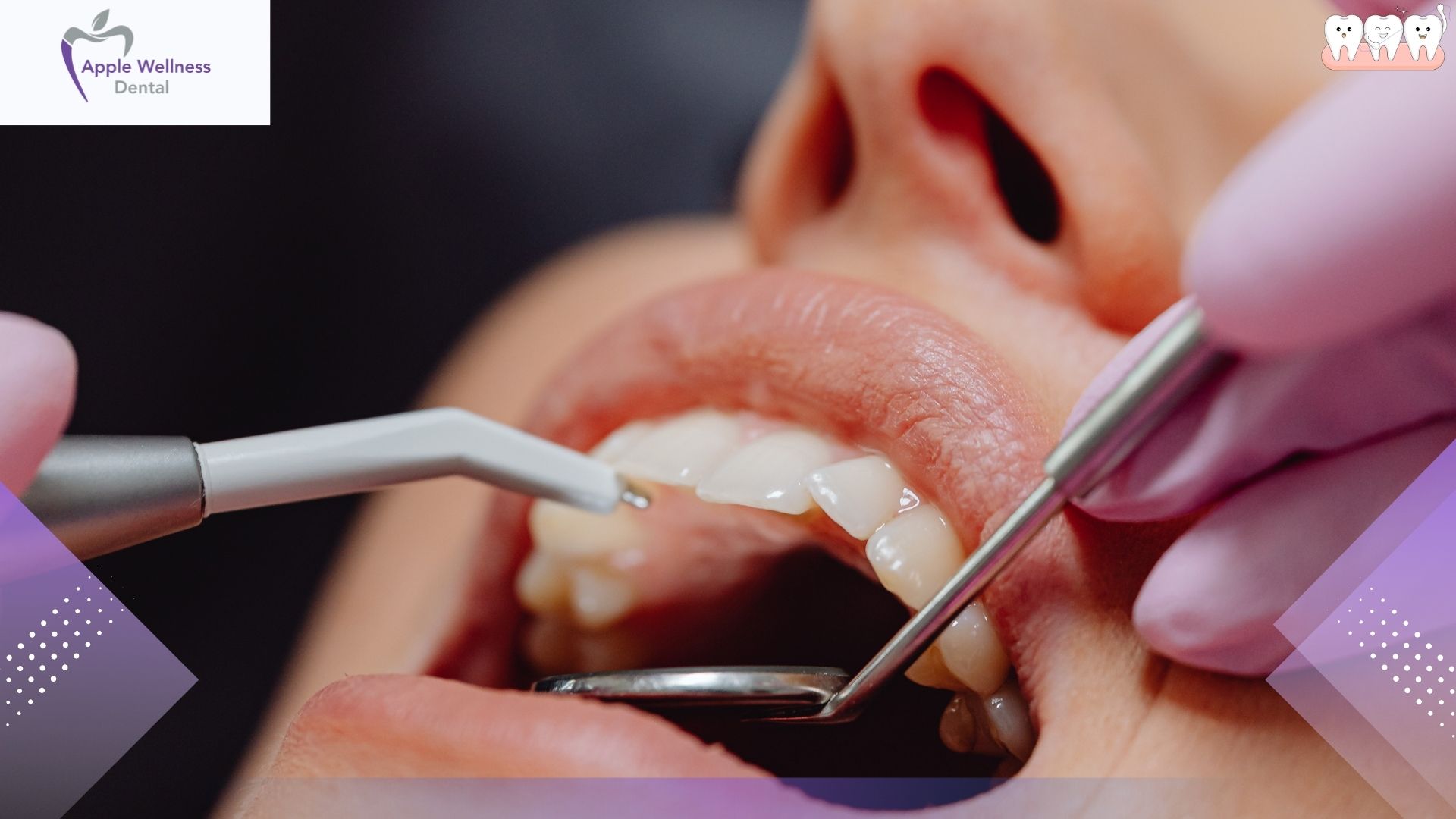 The 72-Hour Rule: When Is It Safe to Smoke After Getting a Tooth Pulled? - Apple Wellness Dental