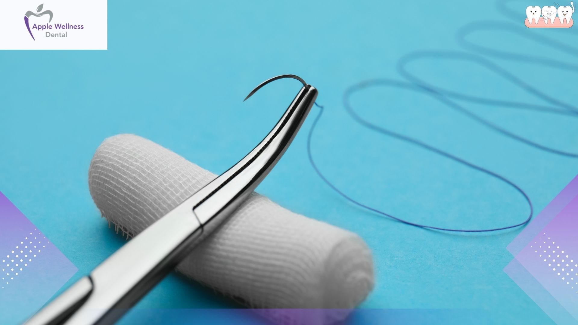 How Long After Tooth Extraction Can You Safely Use a Straw? - Apple Wellness Dental