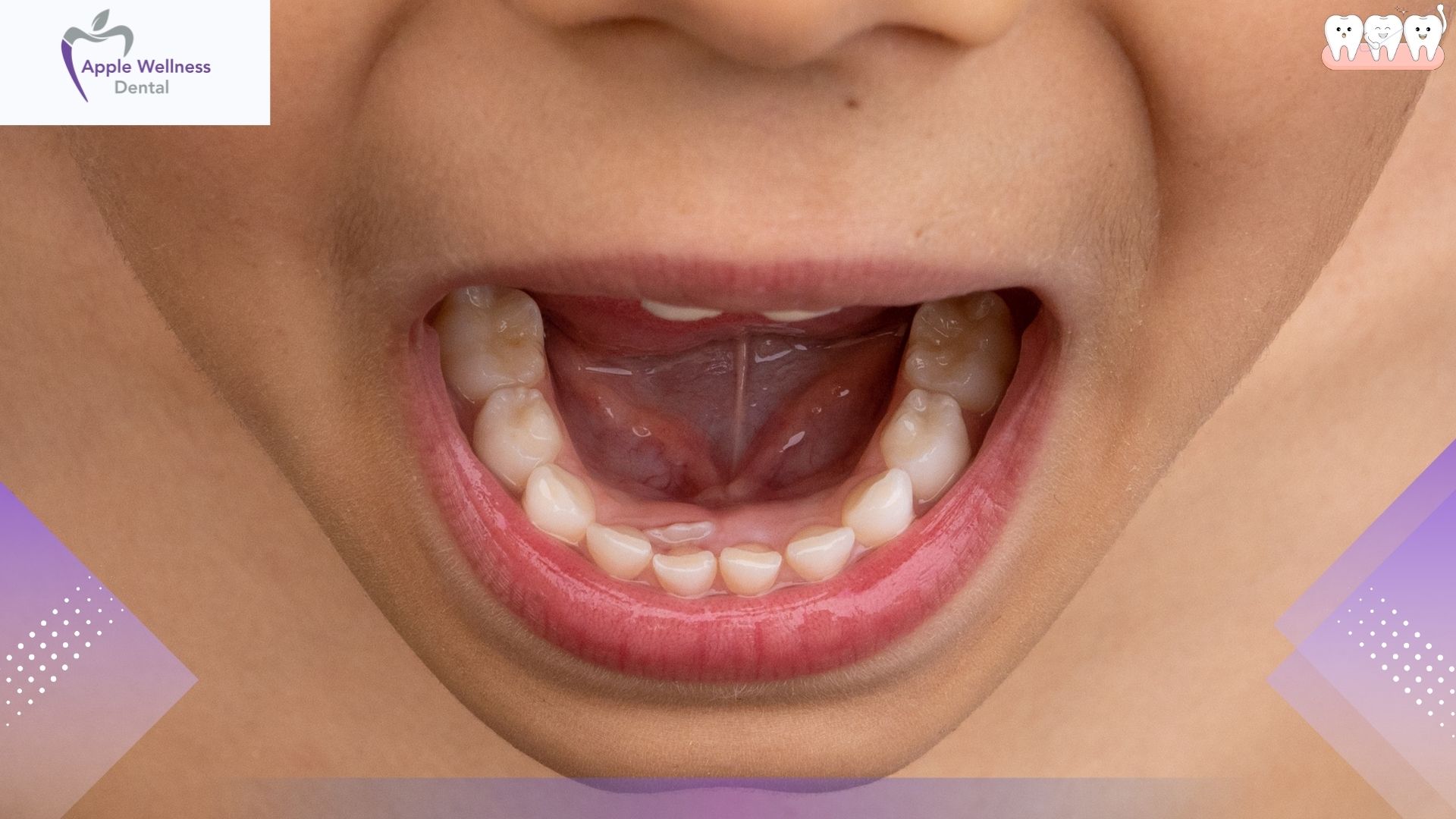 What Are Primary and Permanent Teeth - Apple Wellness Dental