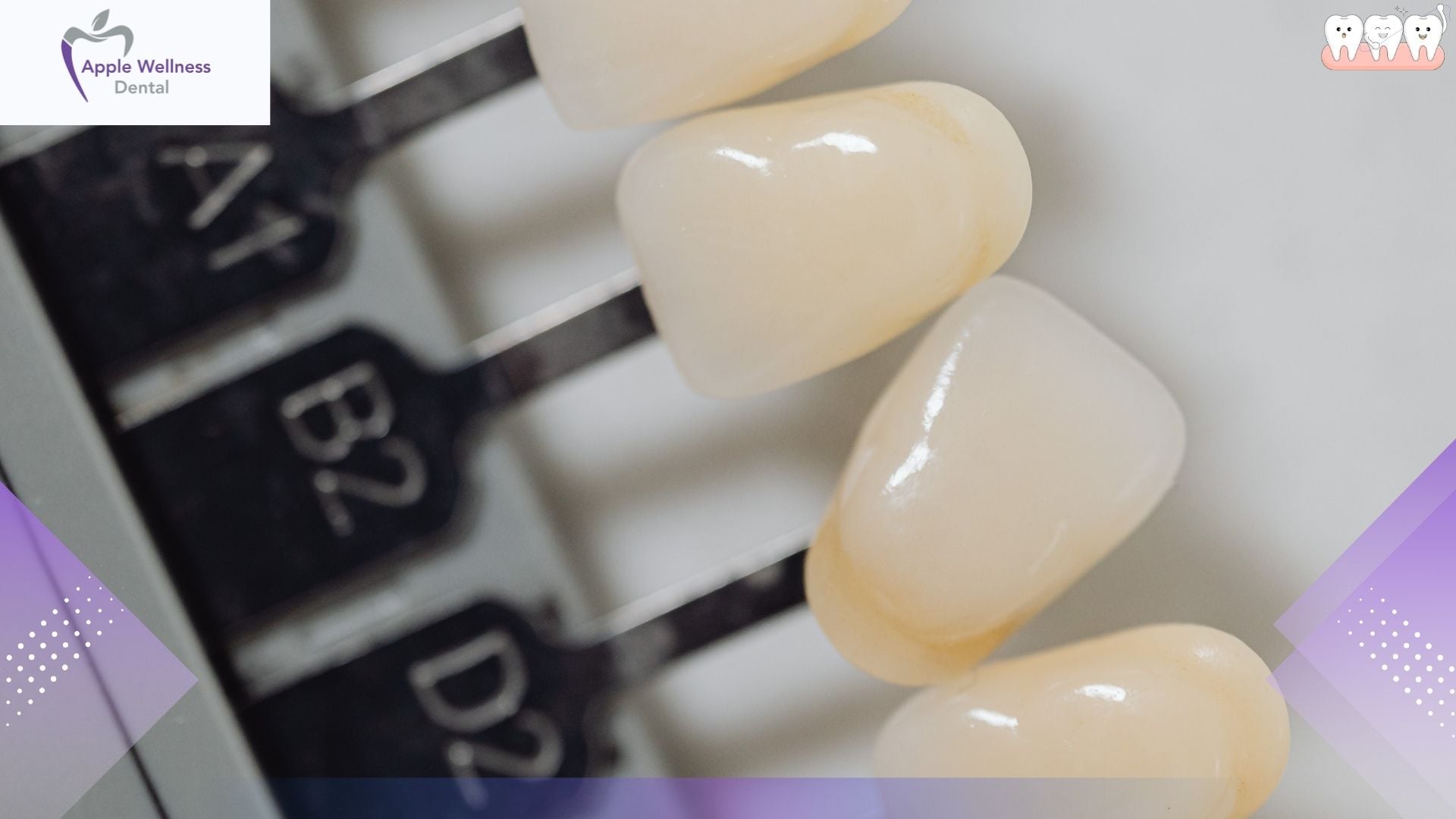 Are Veneers Expensive? A Straightforward Breakdown of What Drives the Price - Apple Wellness Dental Are Veneers Expensive? A Straightforward Breakdown of What Drives the Price - Apple Wellness Dental