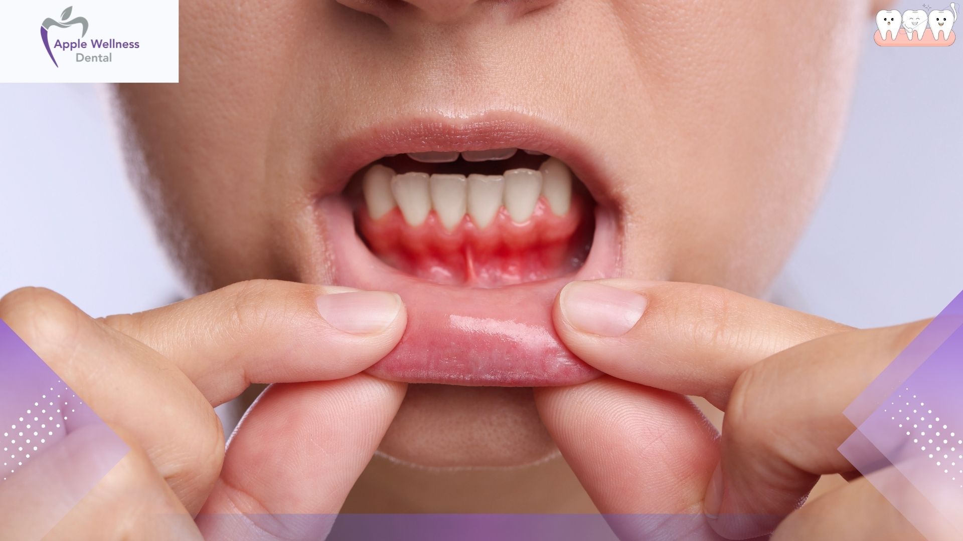 How Long Does It Take to Get Rid of Gingivitis - Apple Wellness Dental