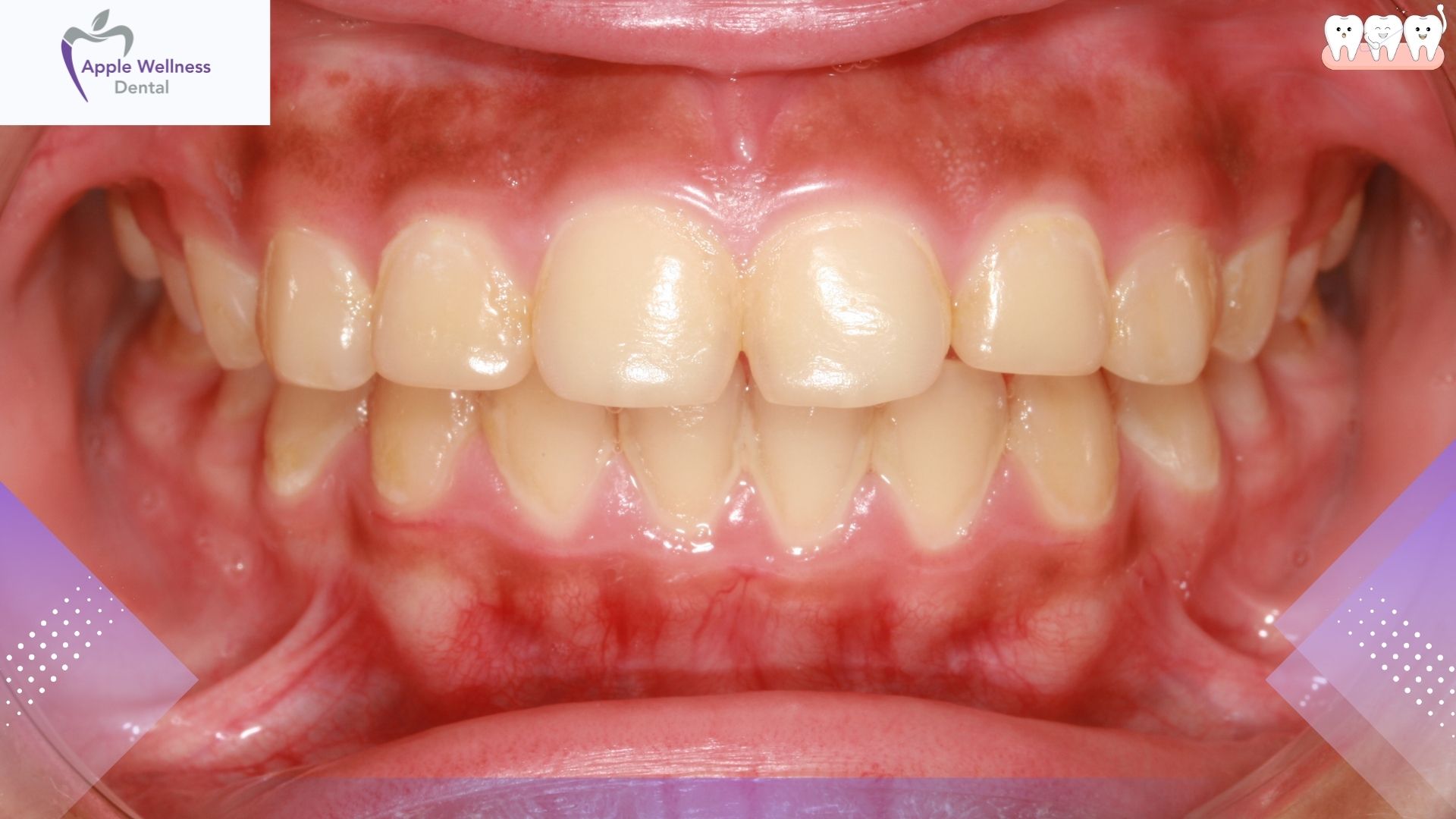 Gingivitis Healing Time: How Long Before Your Gums Recover? - Apple Wellness Dental Gingivitis Healing Time: How Long Before Your Gums Recover? - Apple Wellness Dental