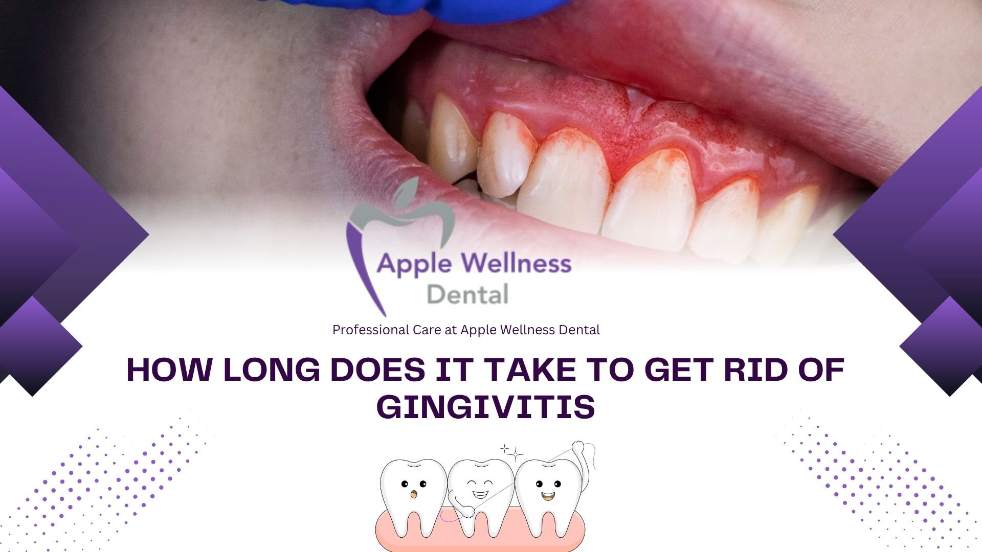 How Long Does It Take to Get Rid of Gingivitis - Apple Wellness Dental