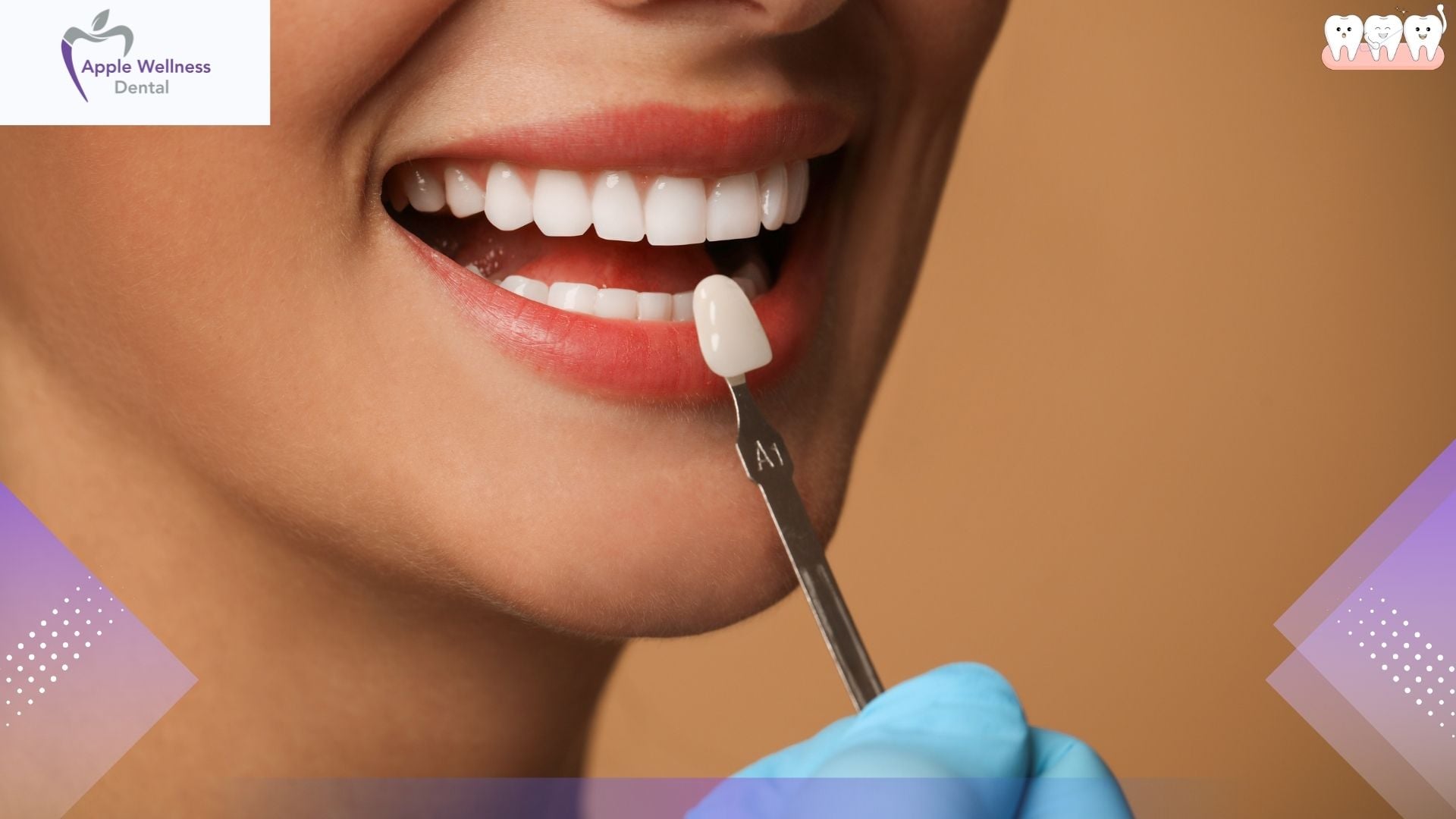 How Long Do Porcelain Veneers Last? A Complete Guide to Longevity - Apple Wellness Dental
